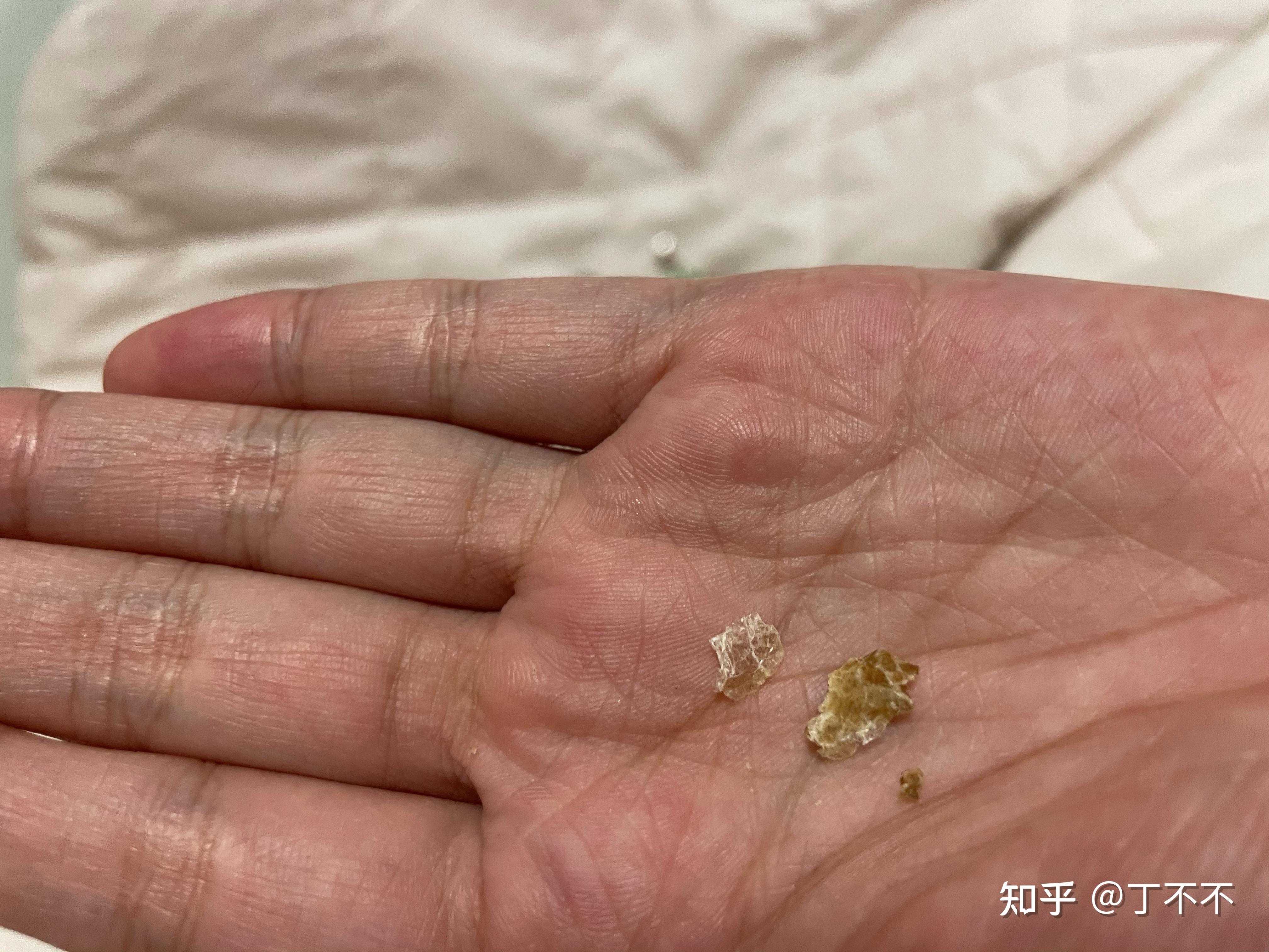 耳朵里长硬耳屎(耵聍)是什么感受? - 知乎