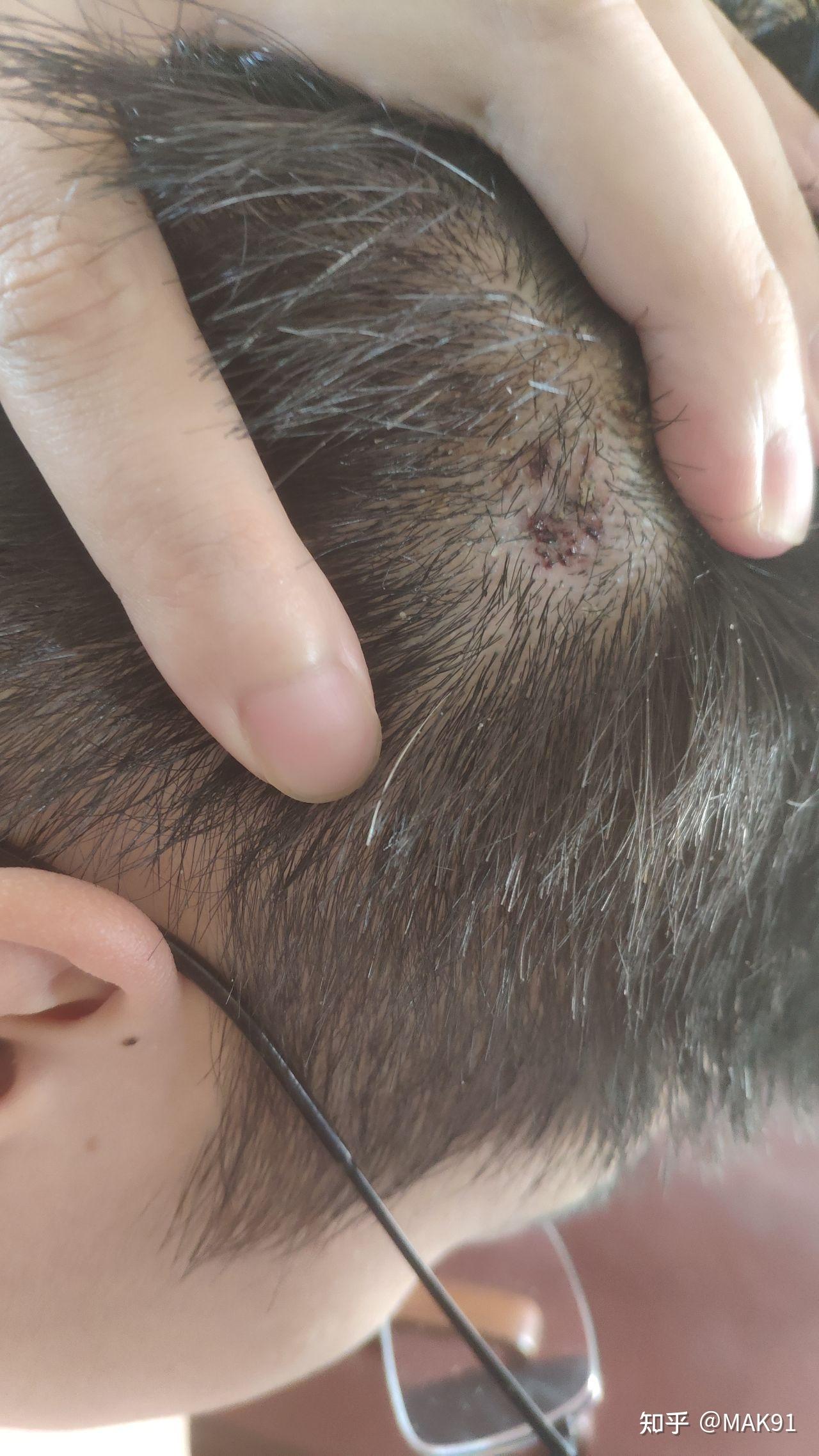 头皮上长了一个红色的小肉球不疼不痒的问一下是啥