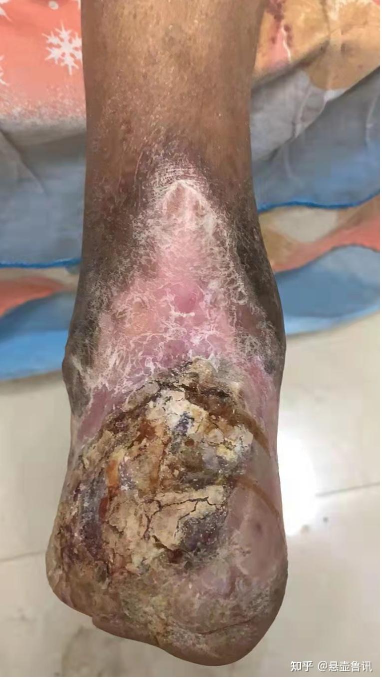 请问我爸爸是脉管炎晚期吃中药可以吗? - 知乎