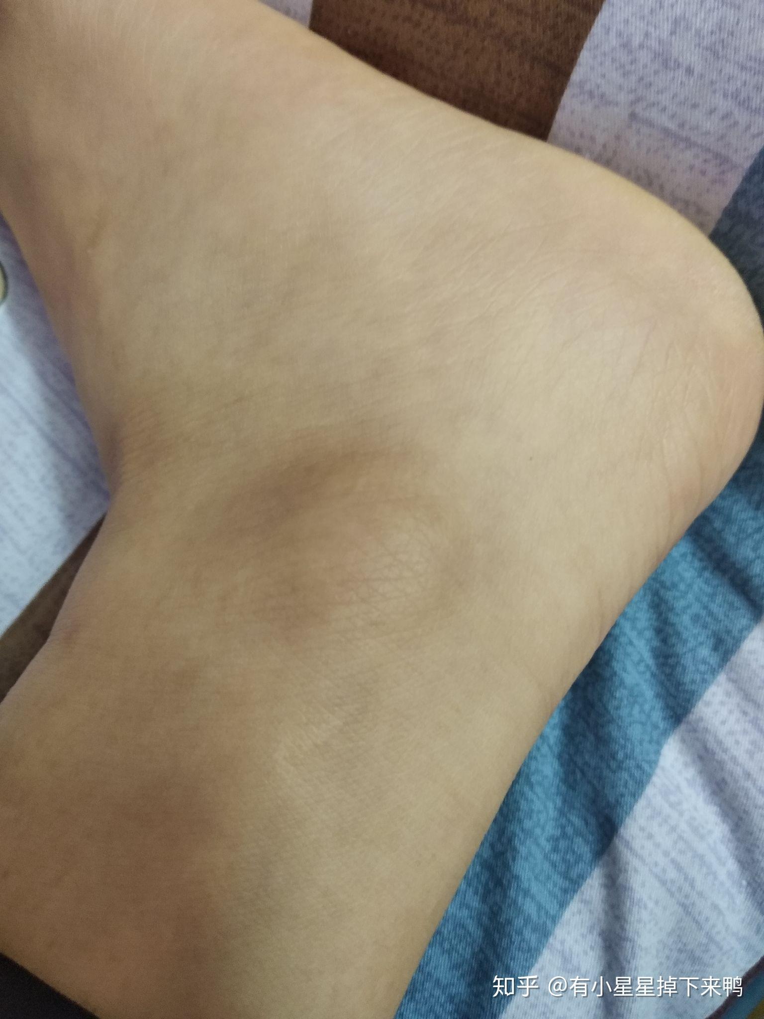 脚踝骨是黑的? - 知乎