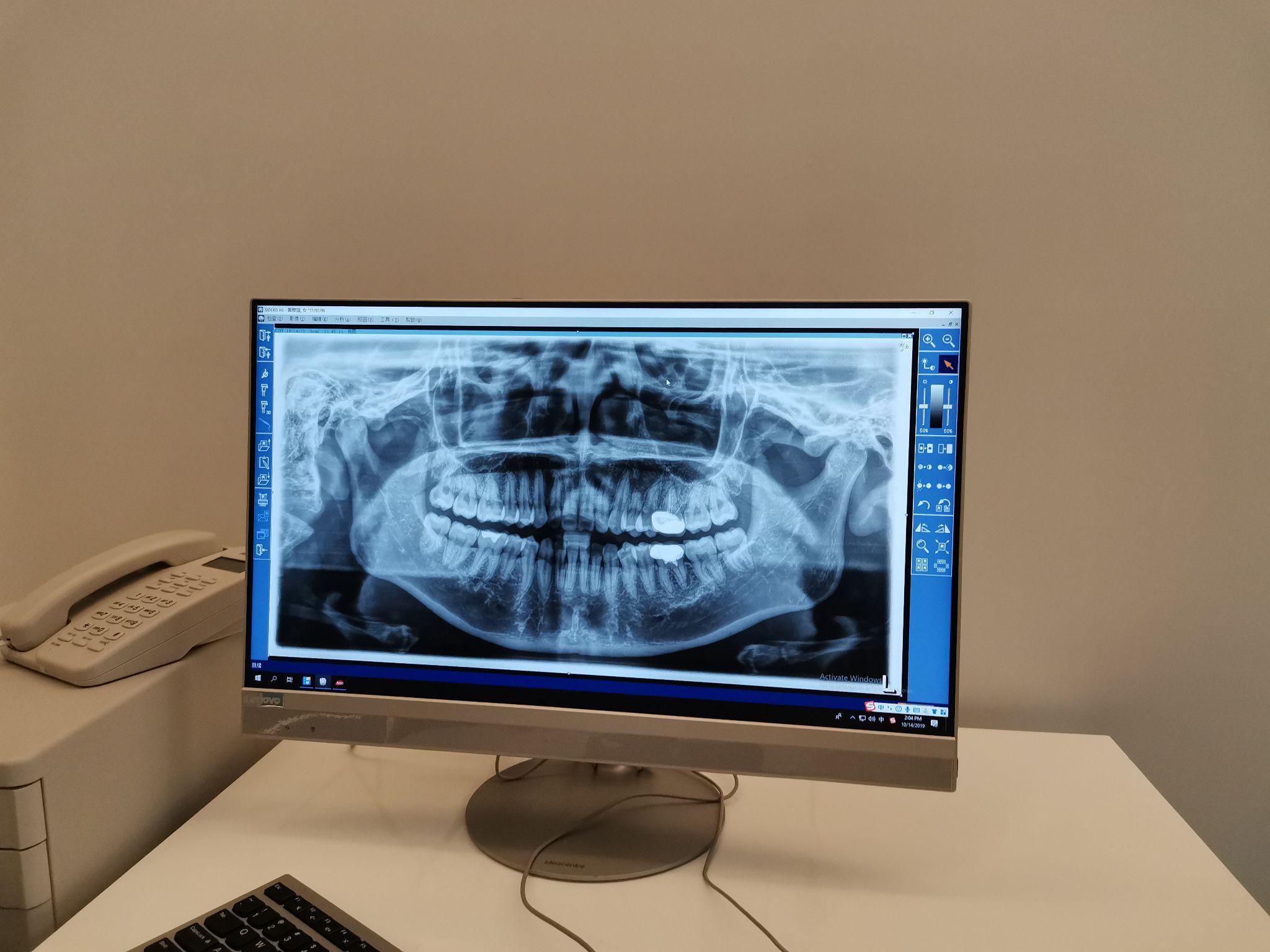 拍牙片发现有智齿但是没有任何感觉如疼痛牙龈红肿那这样的智齿要拔吗