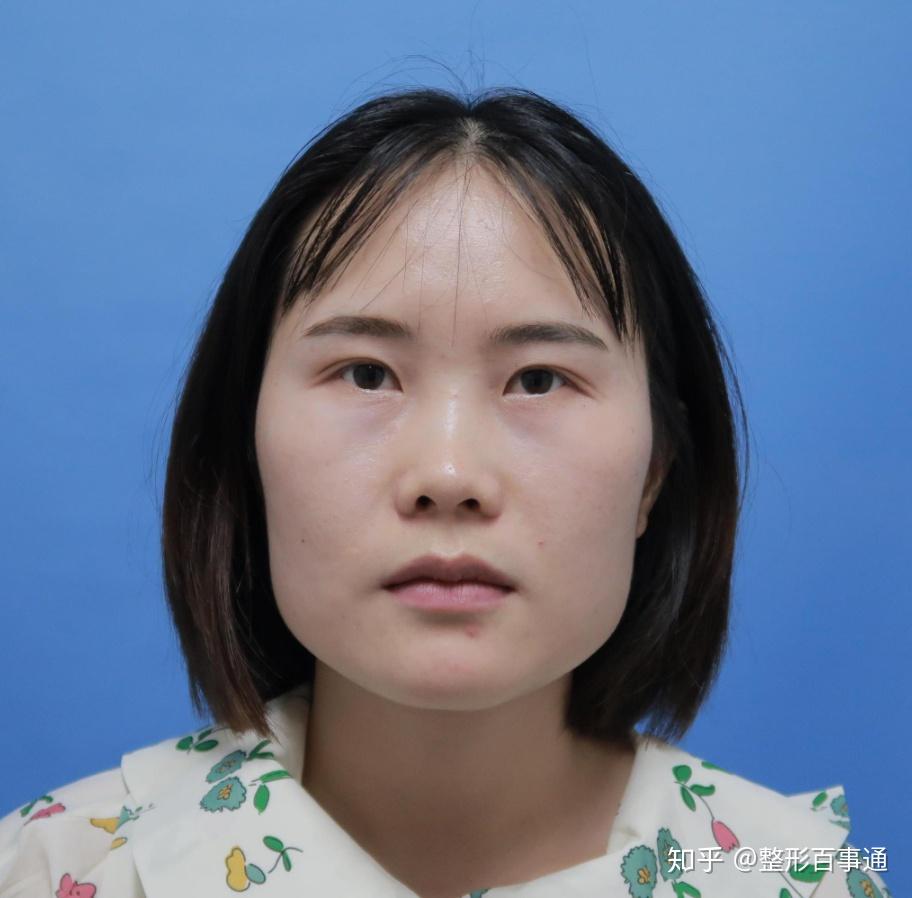 脸大而且是四方脸,想攒钱去整形,得需要花多少钱? - 知乎