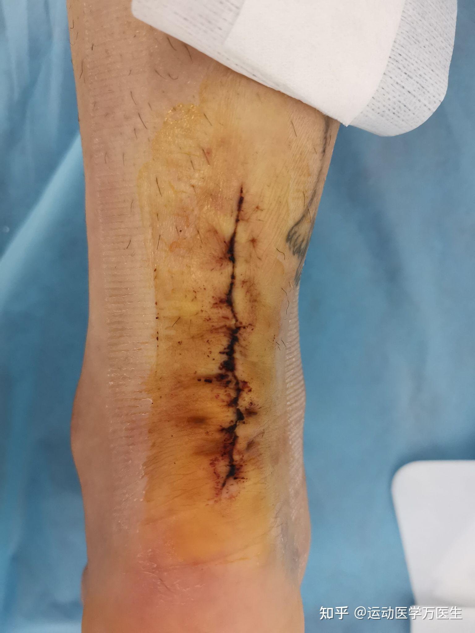 缝针和拆线可怕吗疼吗你们当时怕吗