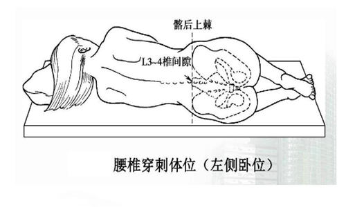 腰椎穿刺可以诊断哪些疾病