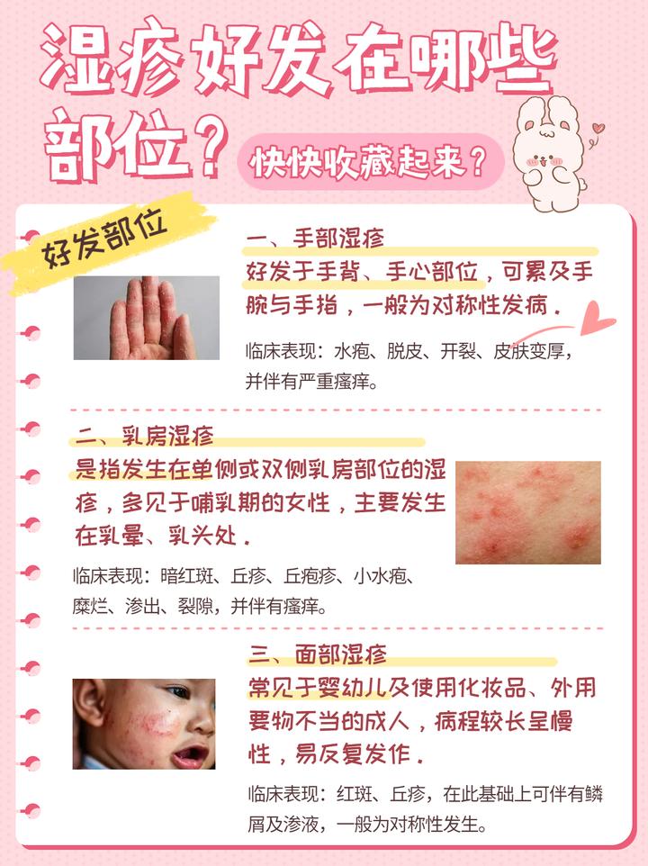 痒痒痒！湿疹好发部位 快来看看你是哪一种吧！ - 知乎