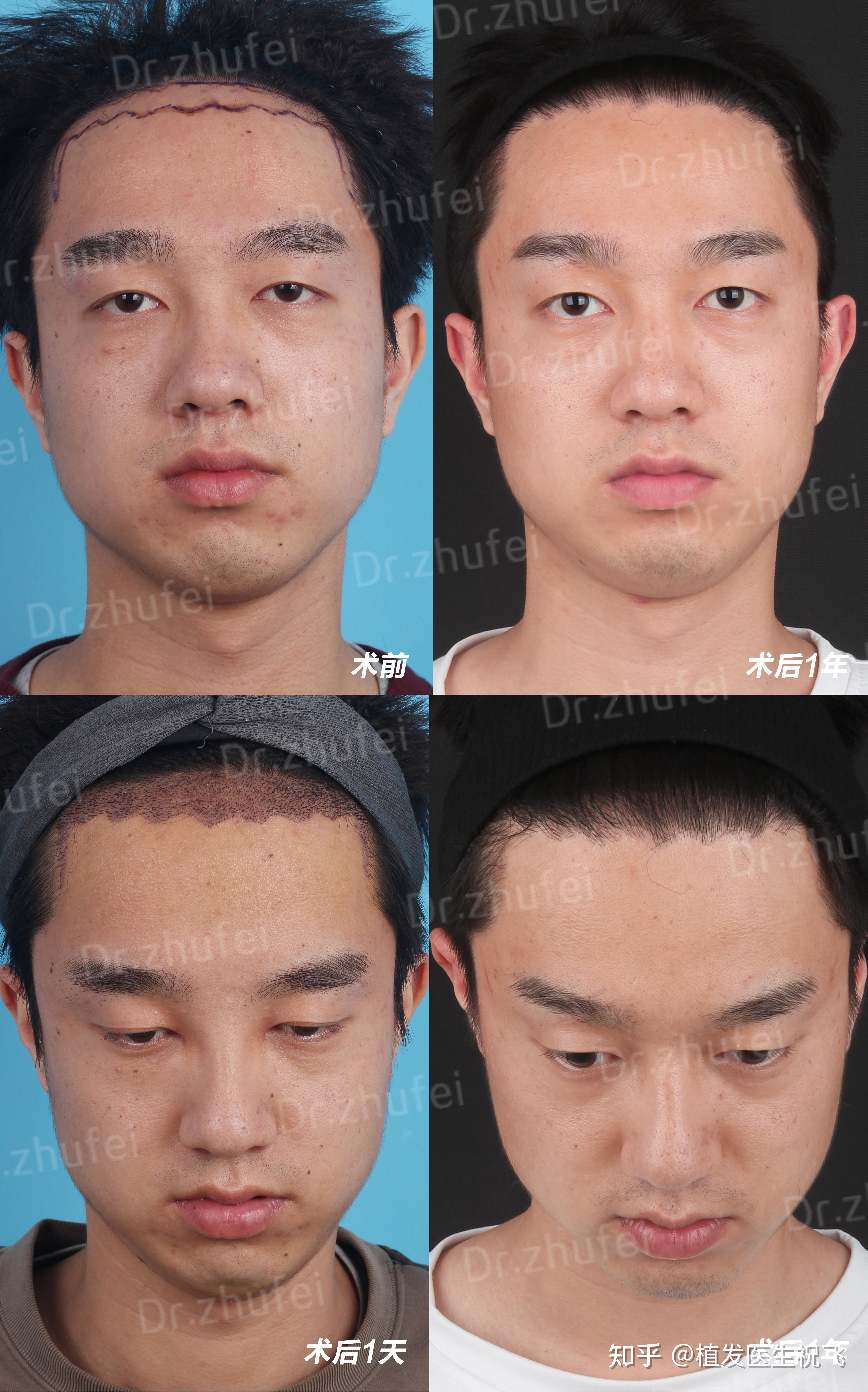 男性发际线一般是什么形状? - 知乎