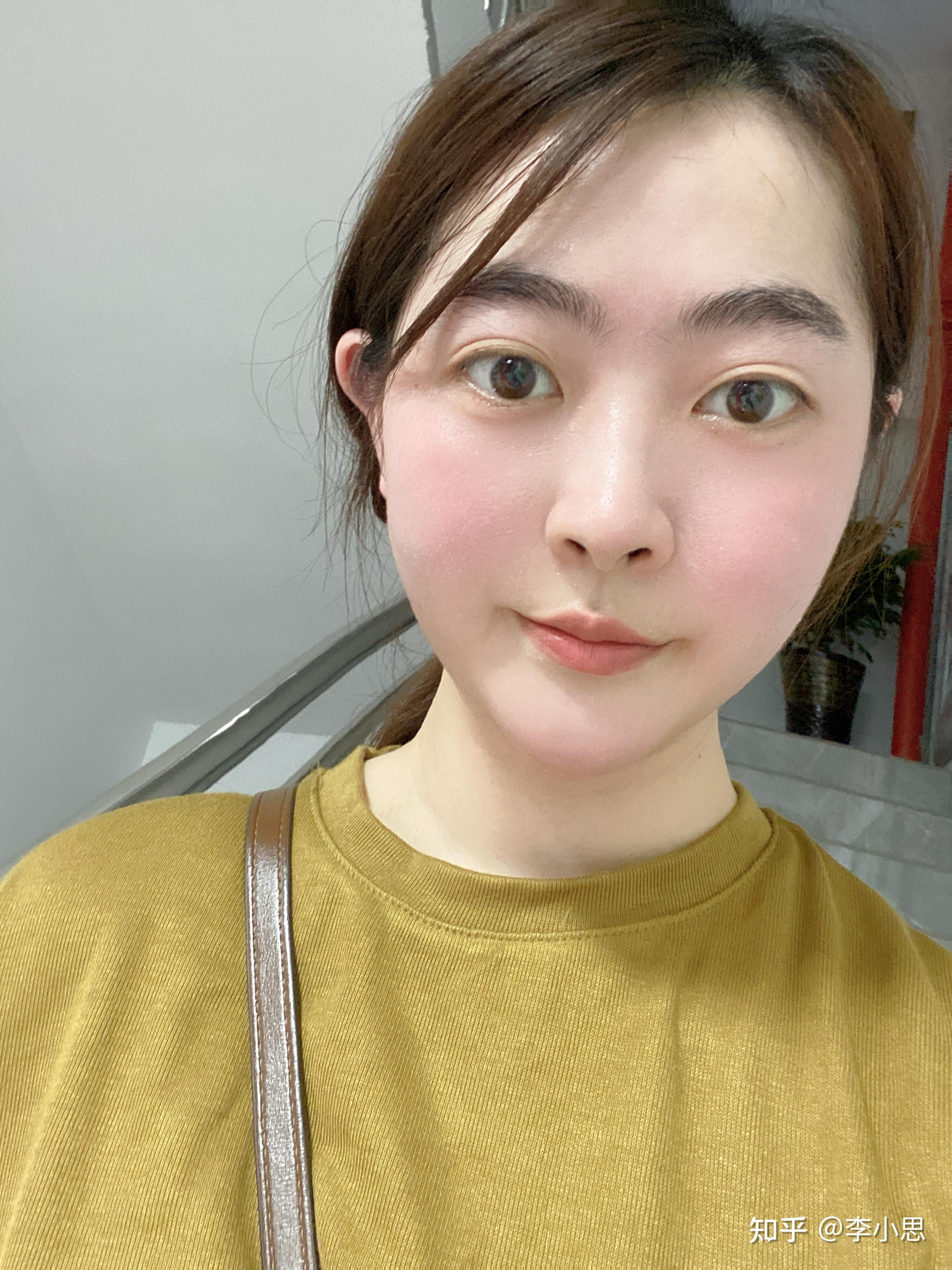 吃糖皮质激素引起的满月脸可以完全恢复吗? - 知乎