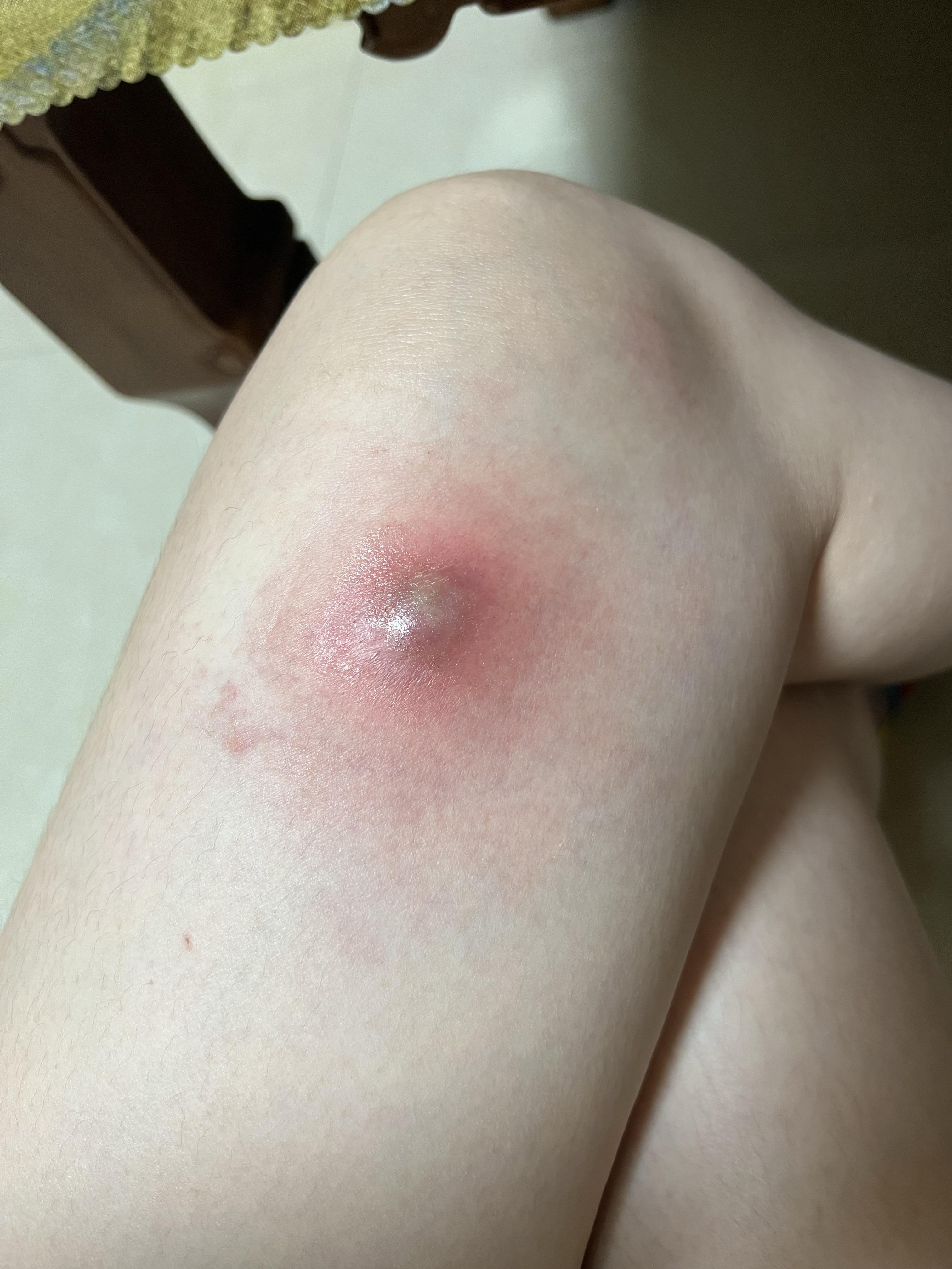 人体的火疖子 (化脓性毛囊及毛囊深部周围组织的感染) 能有多大?