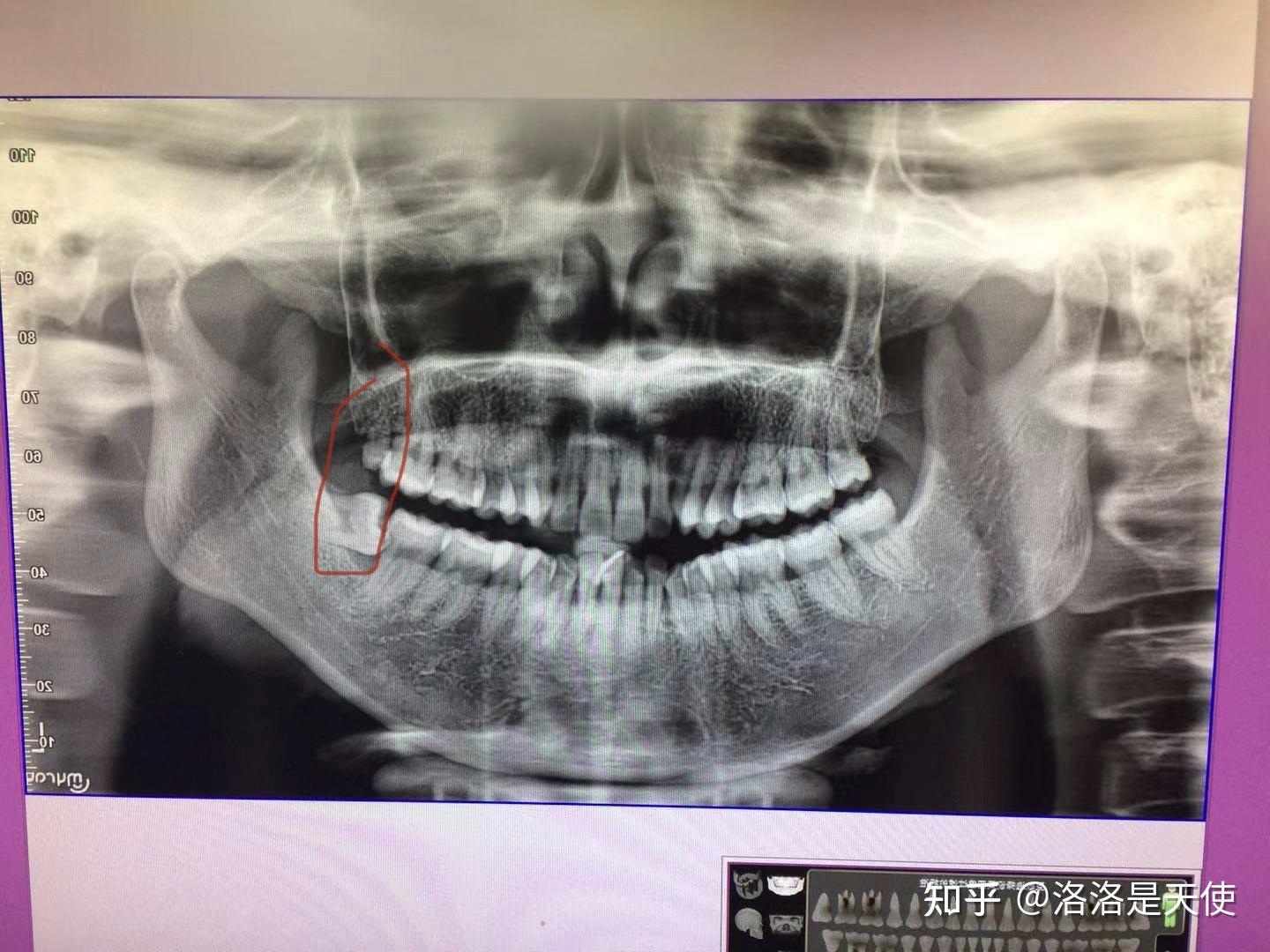 拔一颗横向生长的智齿费用多少? - 知乎