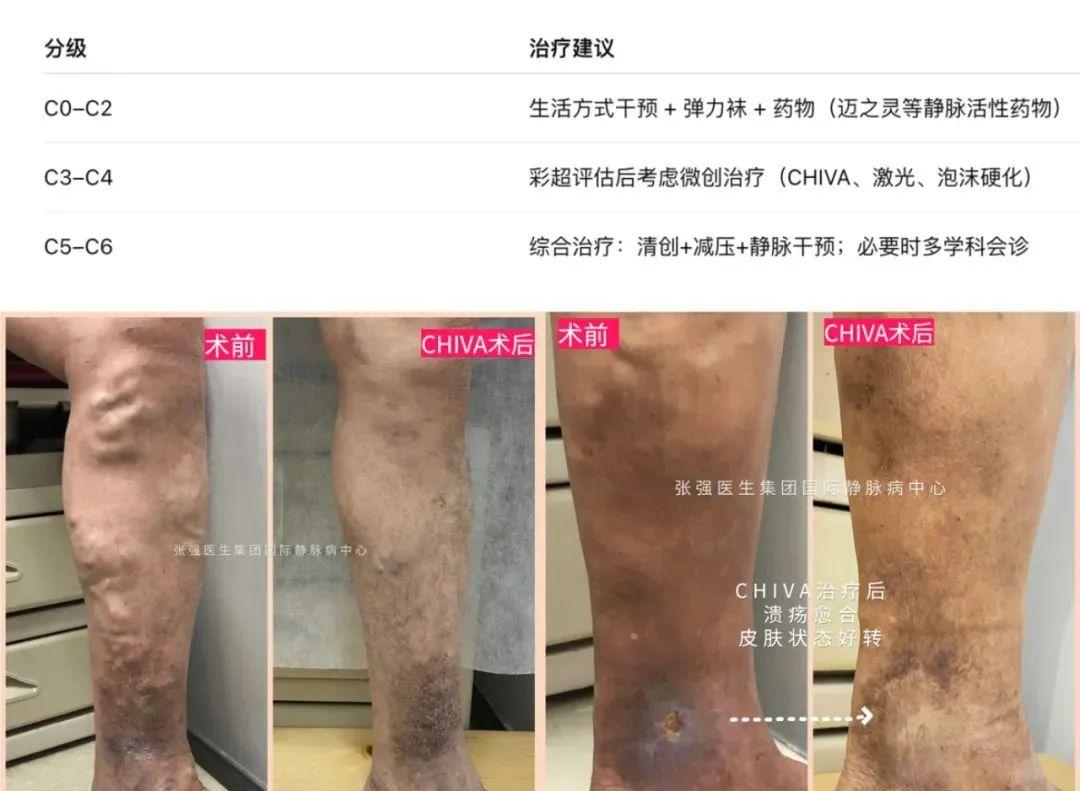 特朗普腿肿,是“静脉功能不全”?这病其实很多人都有! - 知乎