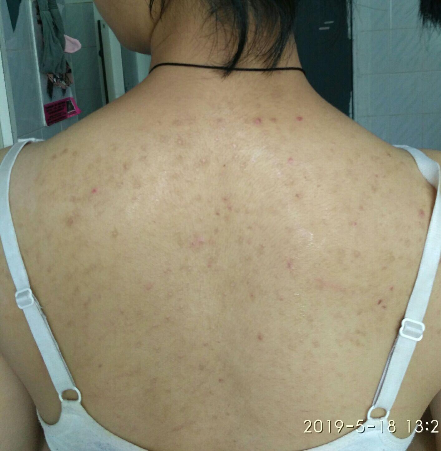 背后长痘并有红色痘印怎么消?背部还可以用去角质膏吗? - 知乎