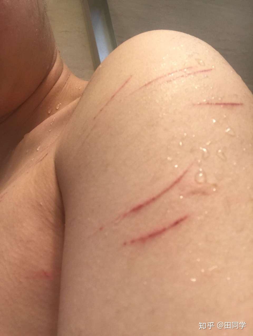 为什么身上会有莫名其妙的抓痕. - 知乎