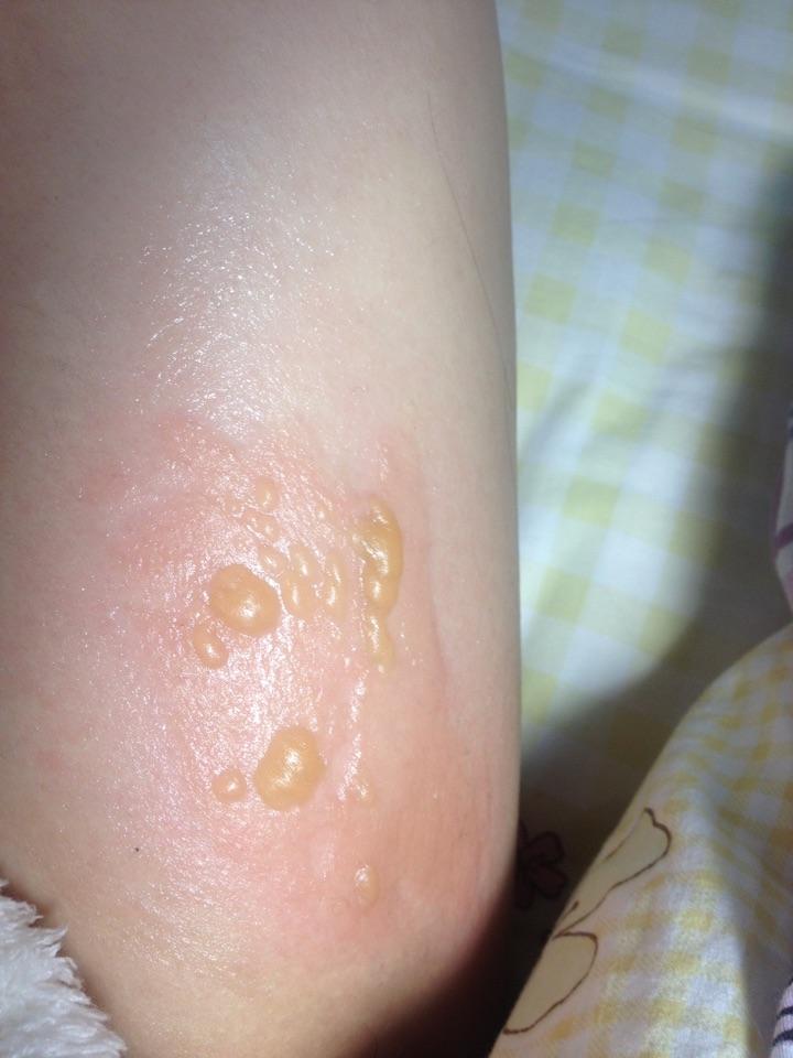 手被开水烫伤了怎么办