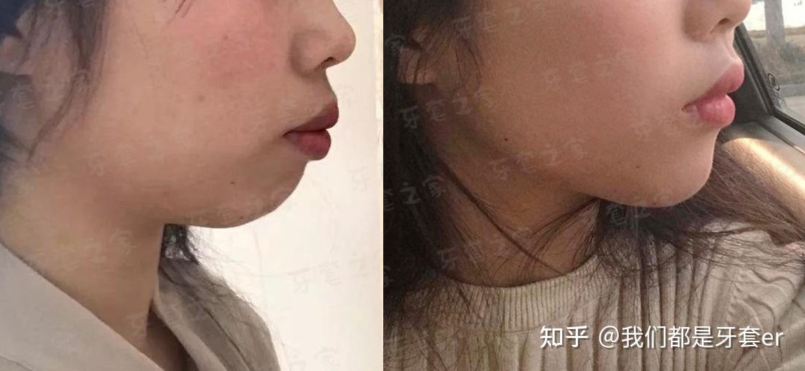 怎样判断嘴凸是骨性的还是牙性的