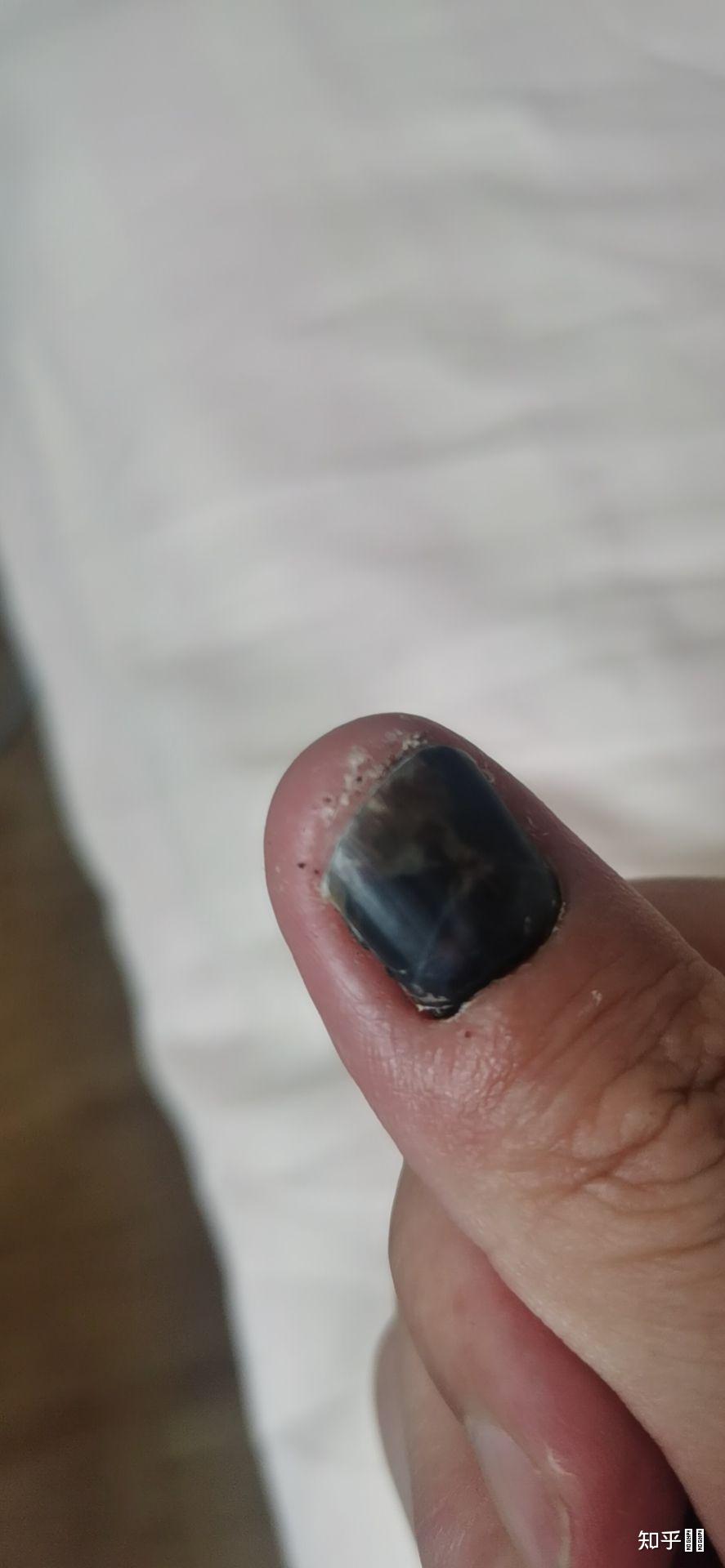 指甲被车门挤伤 指尖全是淤血 怎么办?