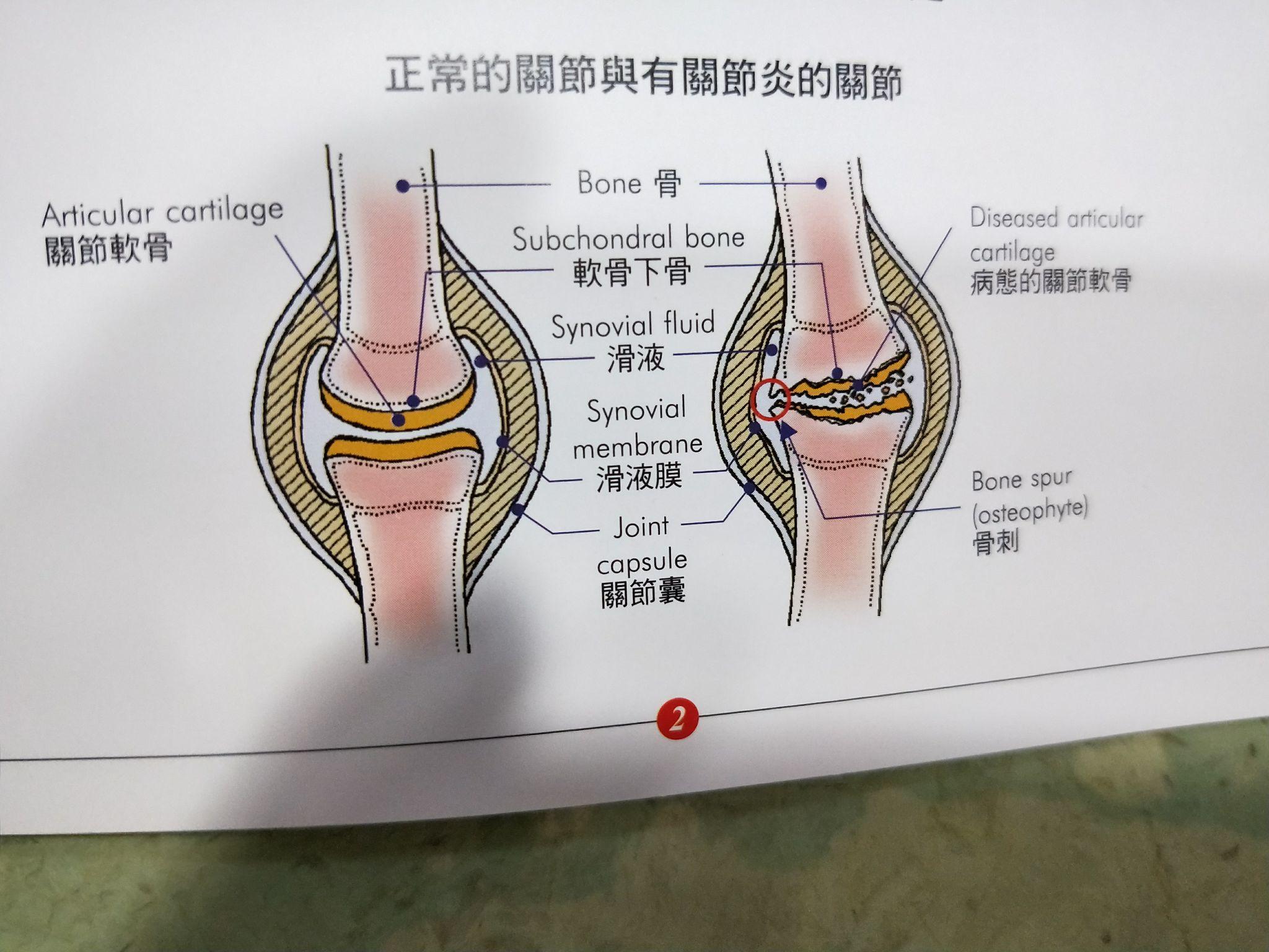 膝蓋半月板恢復方法