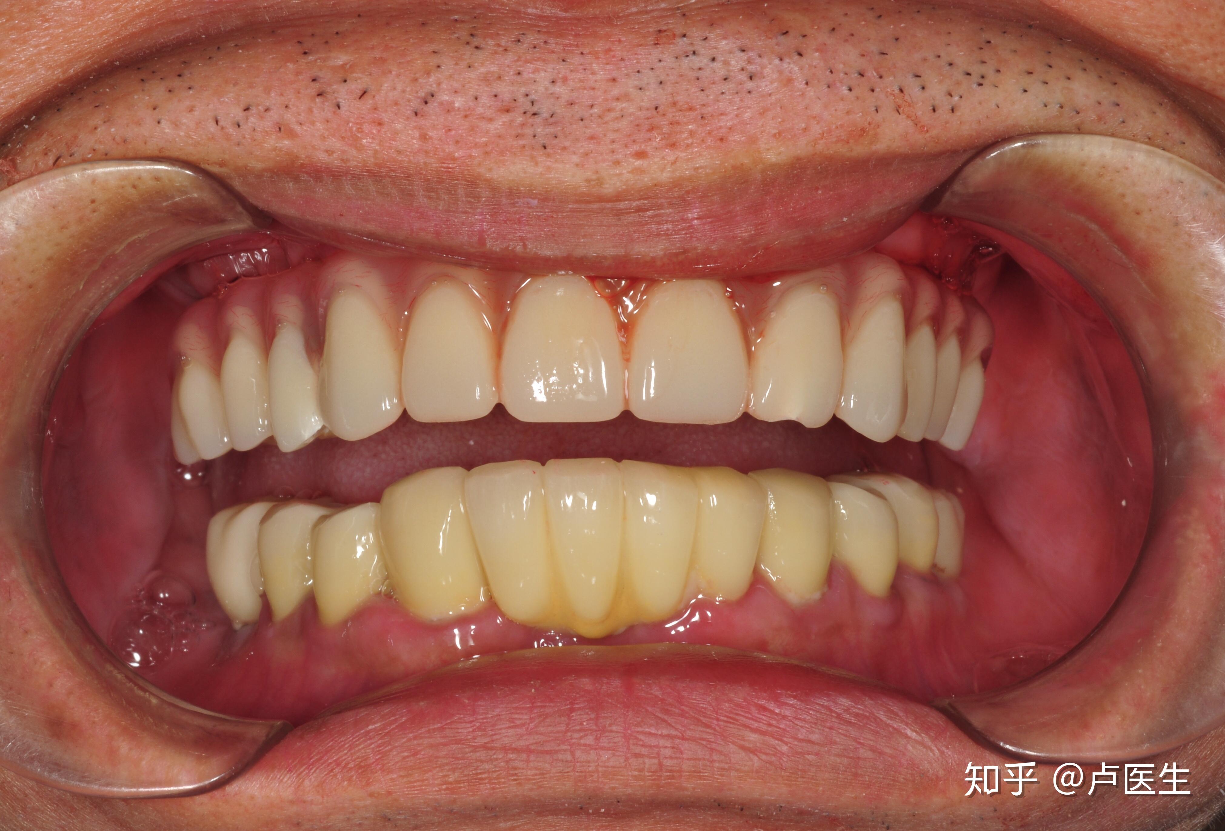 什么是all on 4全口种植牙技术? - 知乎