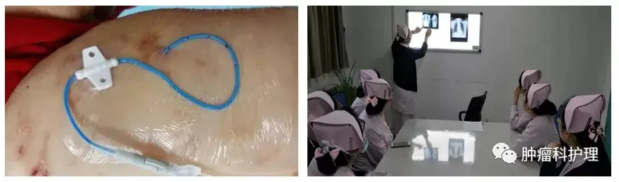 PICC导管脱出多少就不能用了? - 知乎