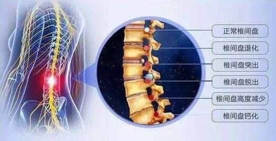 腰间盘突出会有哪些症状?出现这个后果谁都承受不了