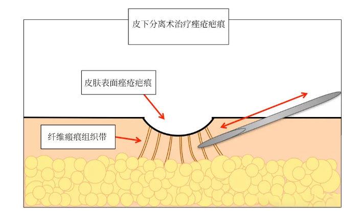 【干货分享】关于皮下剥离（皮下分离）的那些冷知识 - 知乎
