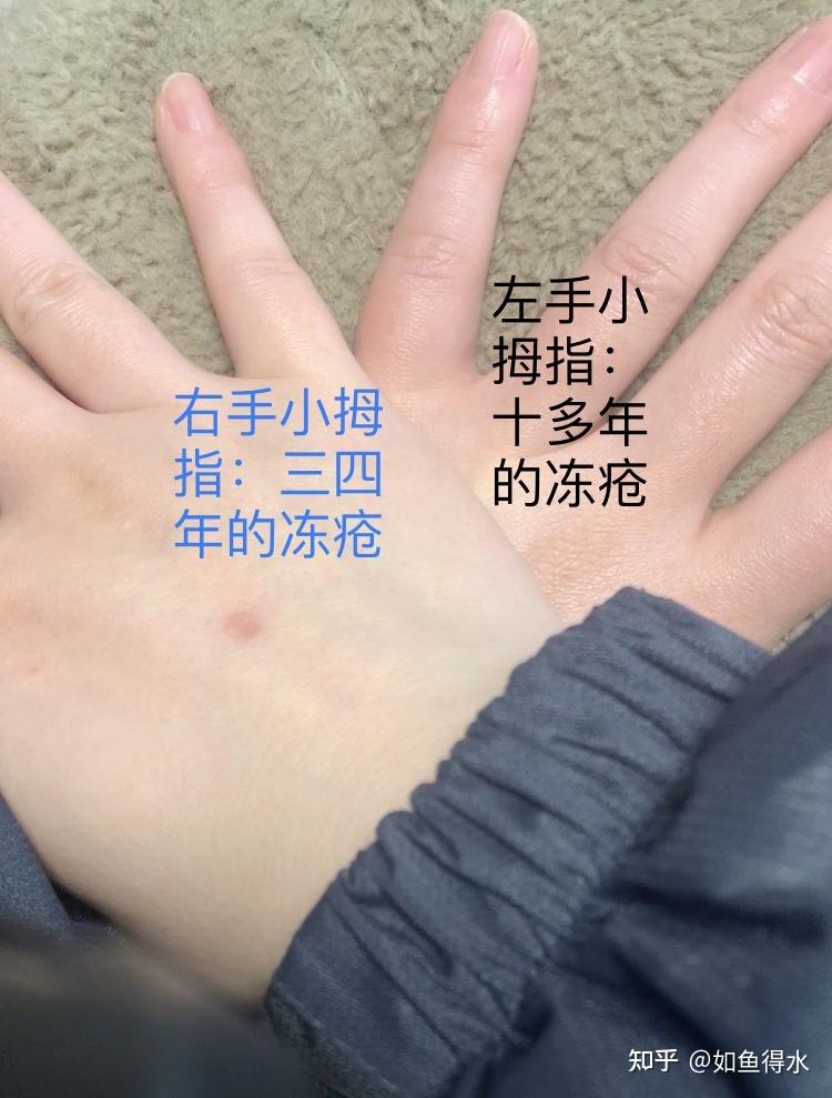 請問大神們手上起凍瘡之後手指又粗又胖而且有硬塊怎麼治啊很羨慕別的