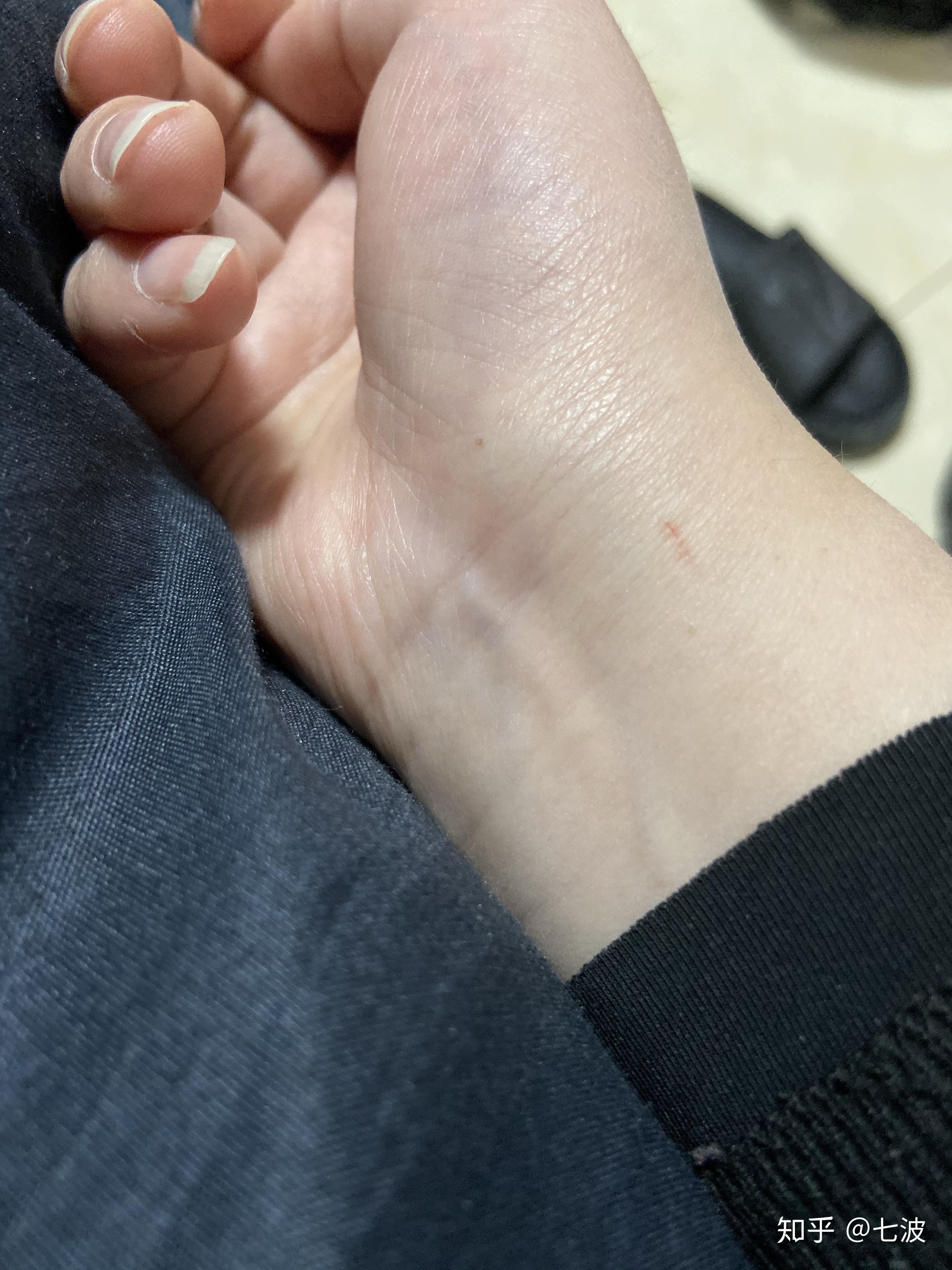 被宠物狗抓出几条痕迹需要打疫苗吗