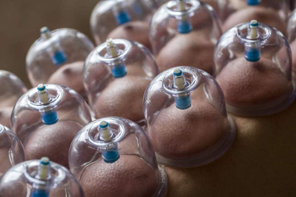 刺络放血疗法可以用针孔气罐吗