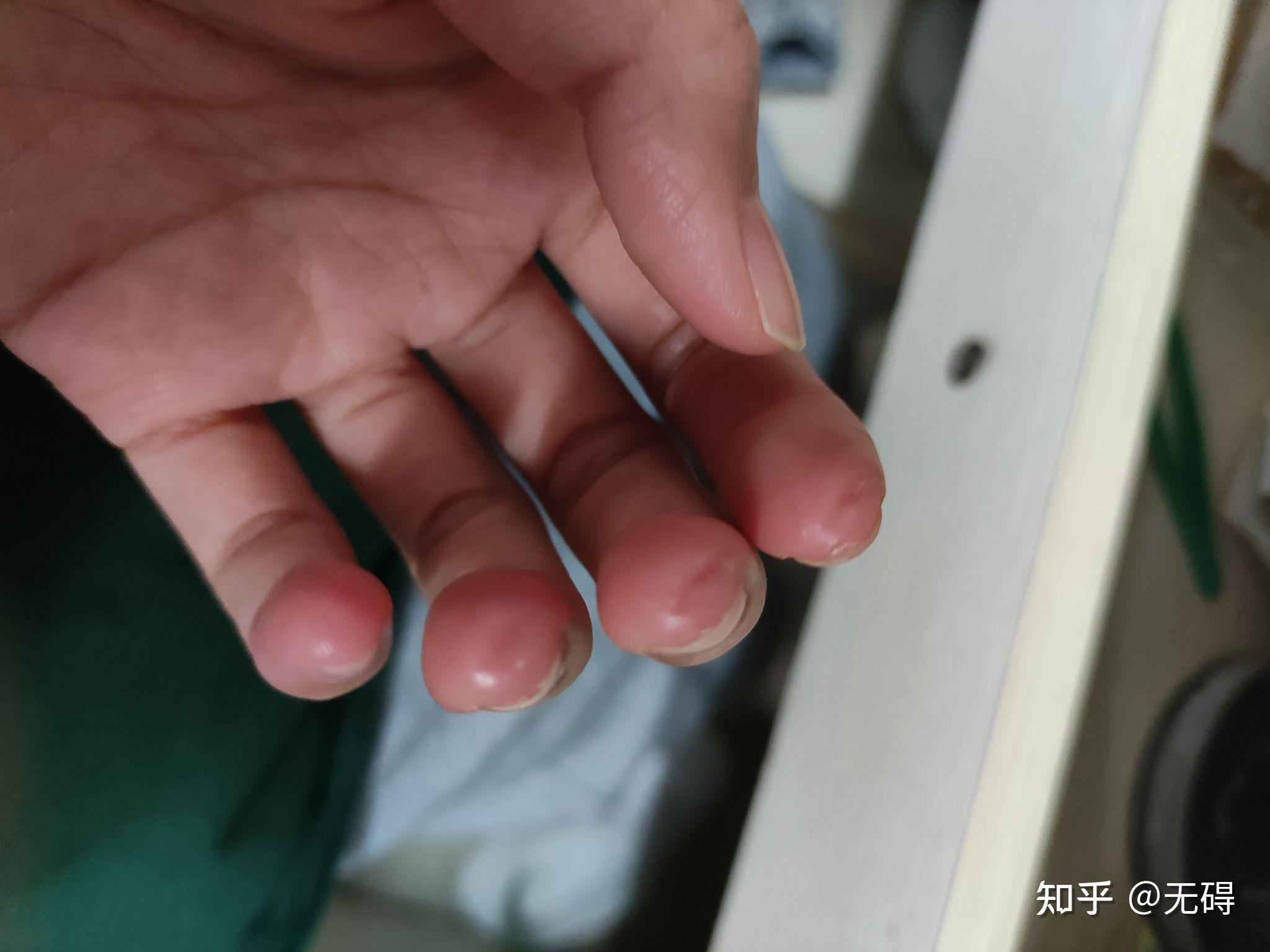 玩吉他的朋友可以拍一张左手手指上的茧吗?