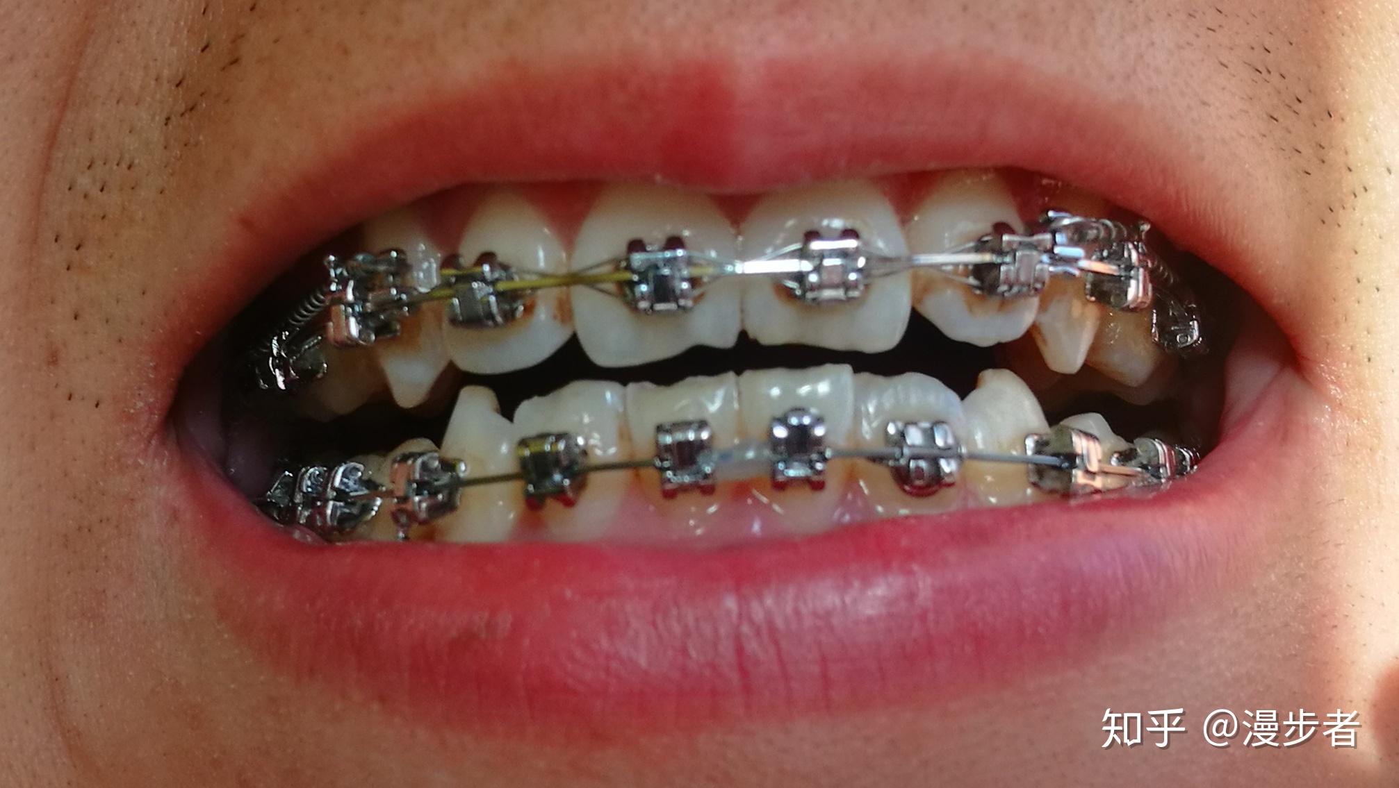 正畸用的进口的自锁托槽和国产的自锁托槽有什么区别?