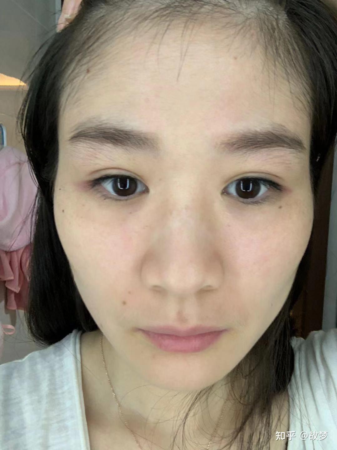 颧骨一高一低后天除手术外如何改善