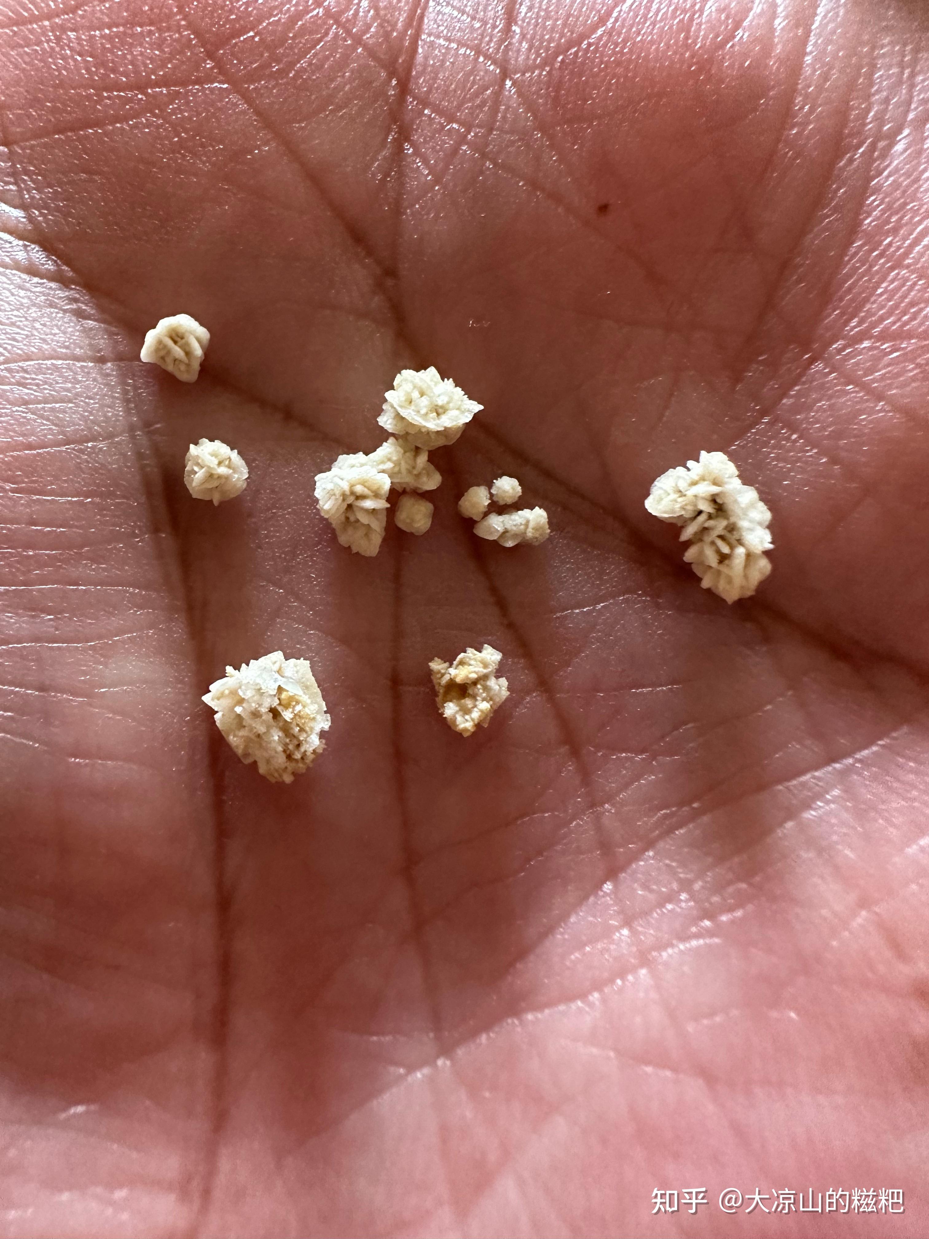 肾结石7毫米可以排出不?