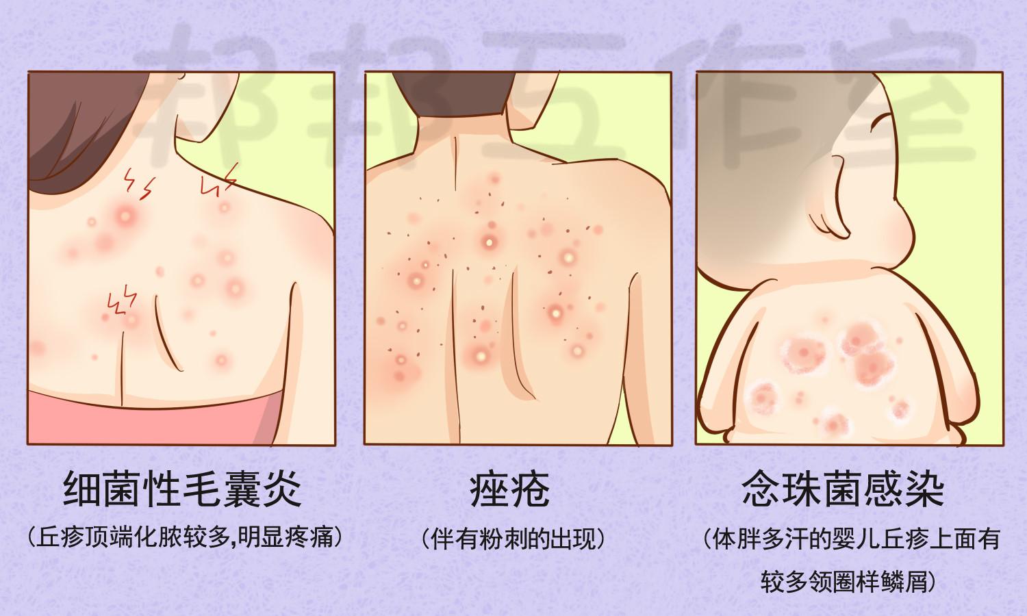 毛囊炎什么是毛囊炎怎么治好治么