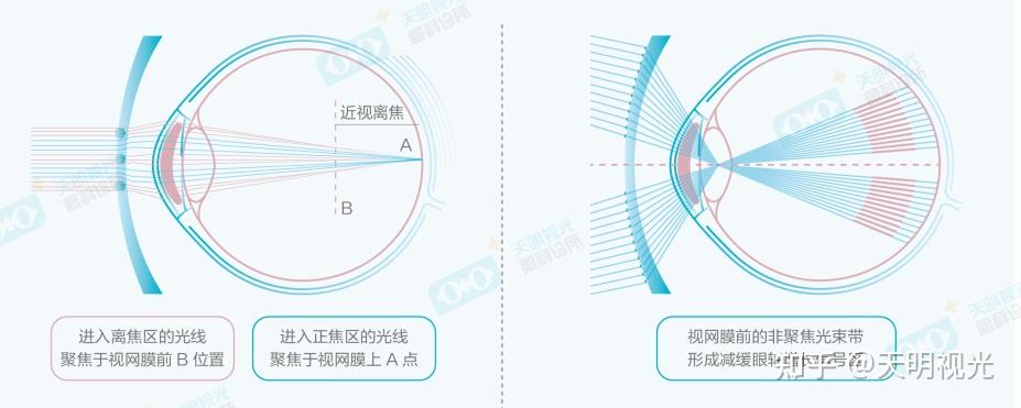 离焦镜是什么原理,真的可以缓解近视吗? - 知乎