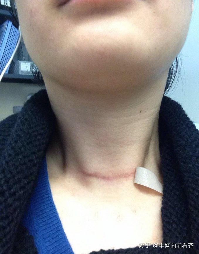甲状腺手术后疤痕如何恢复呢? - 知乎