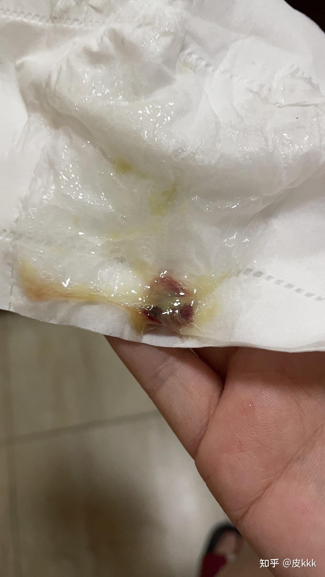 人的鼻屎能大到什么程度?