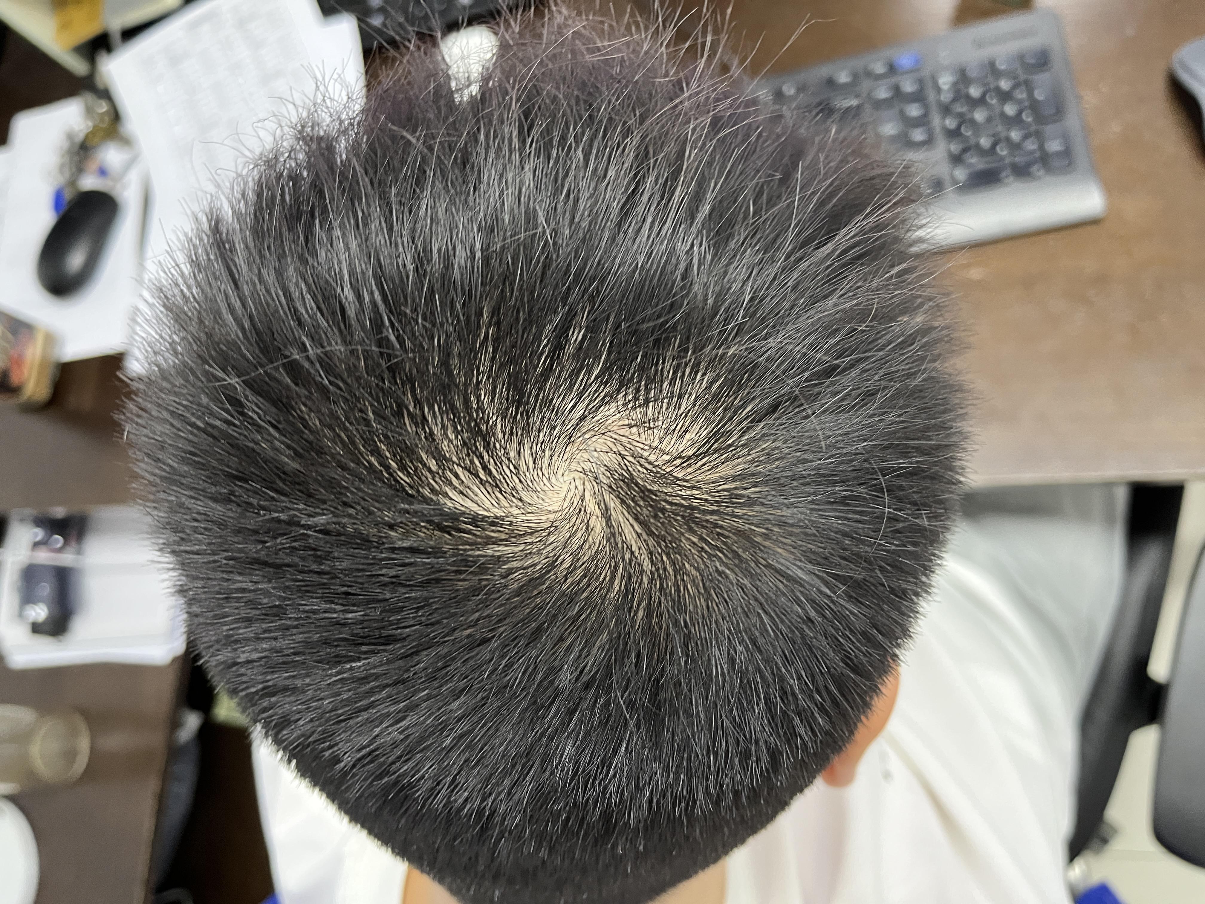 头顶漩涡处头发少会不会秃顶
