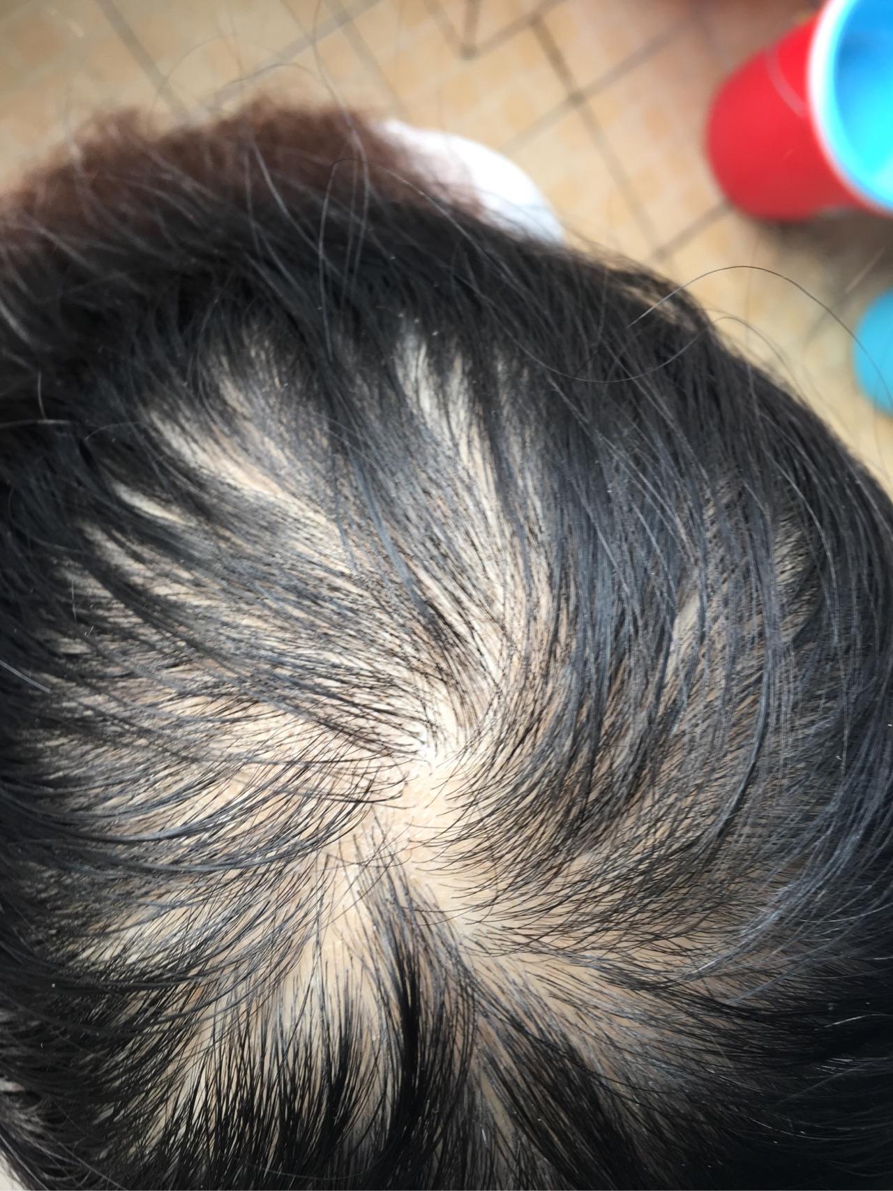 女生22,三年前发现头发越来越少,头发细软少,医院医生说是脂溢性脱发