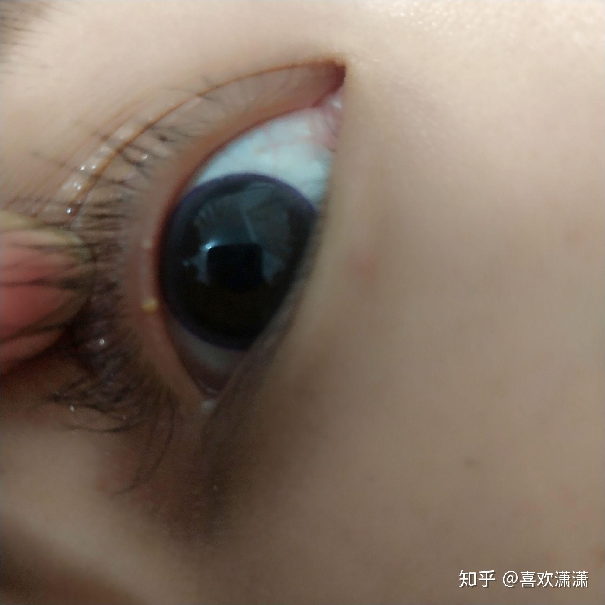 眼皮内的上眼睑长了一个白色颗粒儿点了一个月的日本眼药水也没有用
