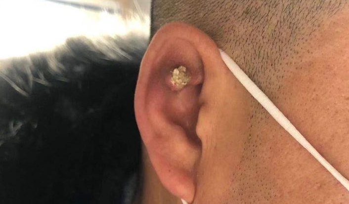 耳朵上有痛风石怎么办怎么消除耳朵上的痛风石