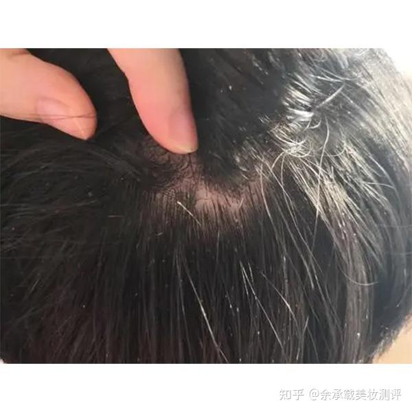 头皮痒头屑用什么洗发水?去屑控油止痒洗发水男 - 知乎