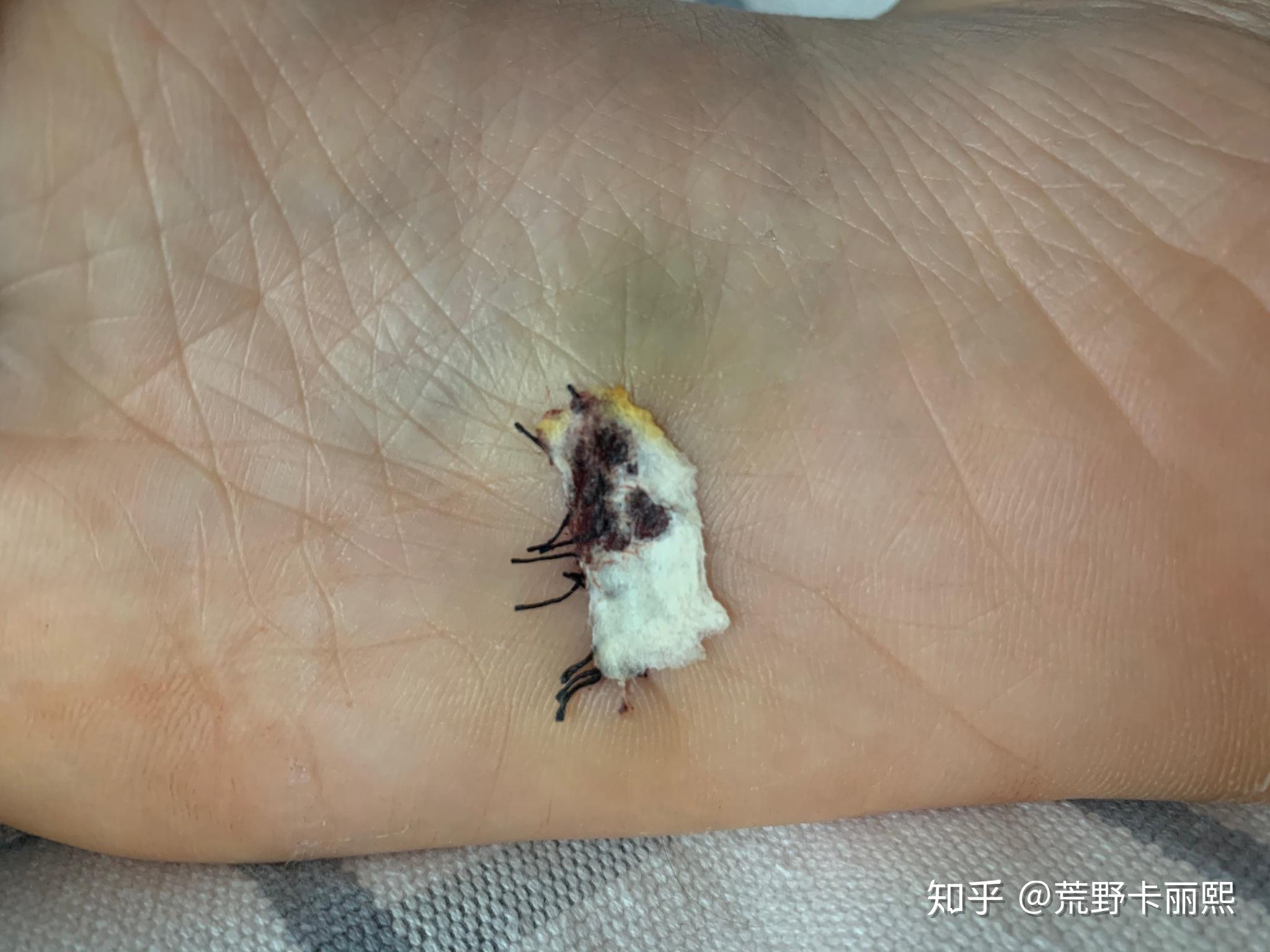 手术切脚底痣是怎么样的体验? - 知乎
