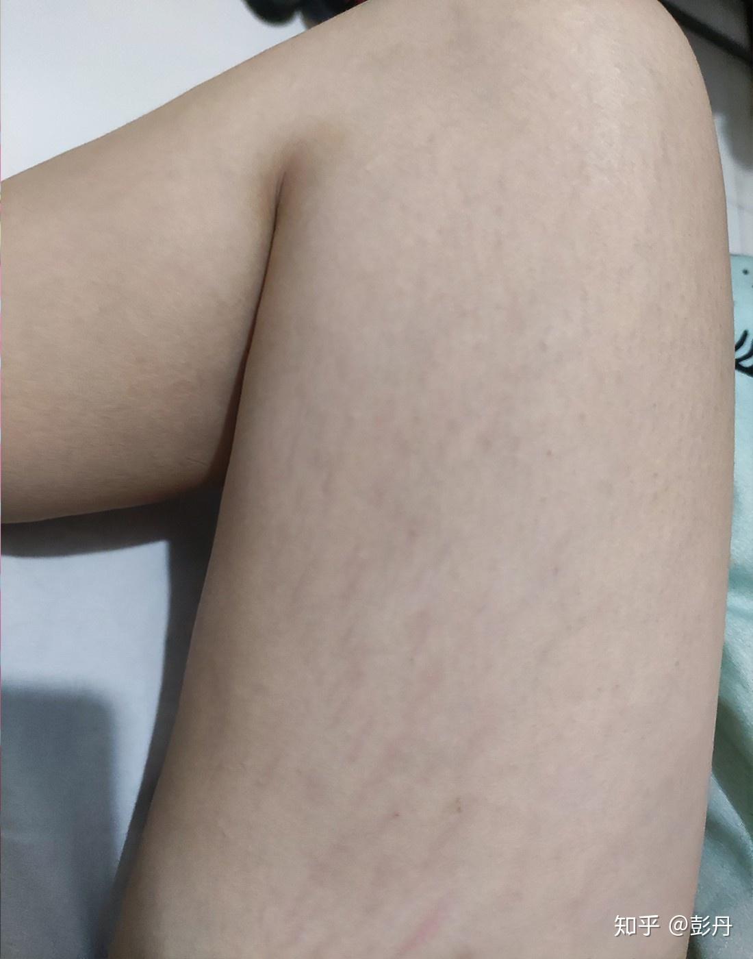 这样的肥胖纹是哪个时期,是不是没救了? - 知乎