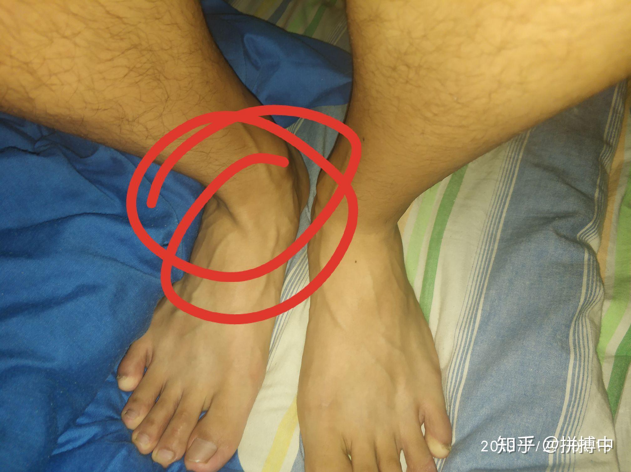 为什么我穿鞋的时候脚总是会歪