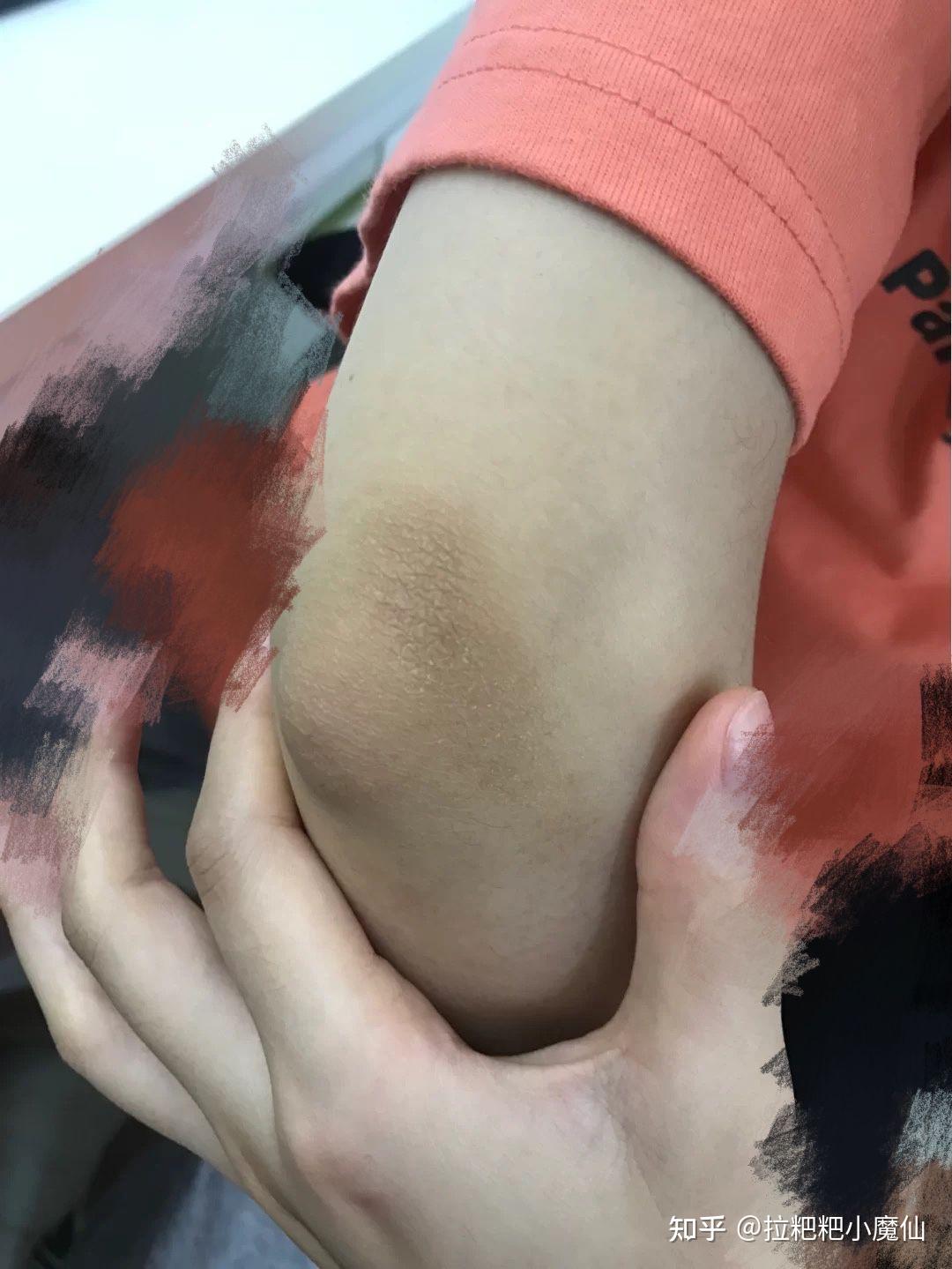 胳膊肘黑怎么办? - 知乎