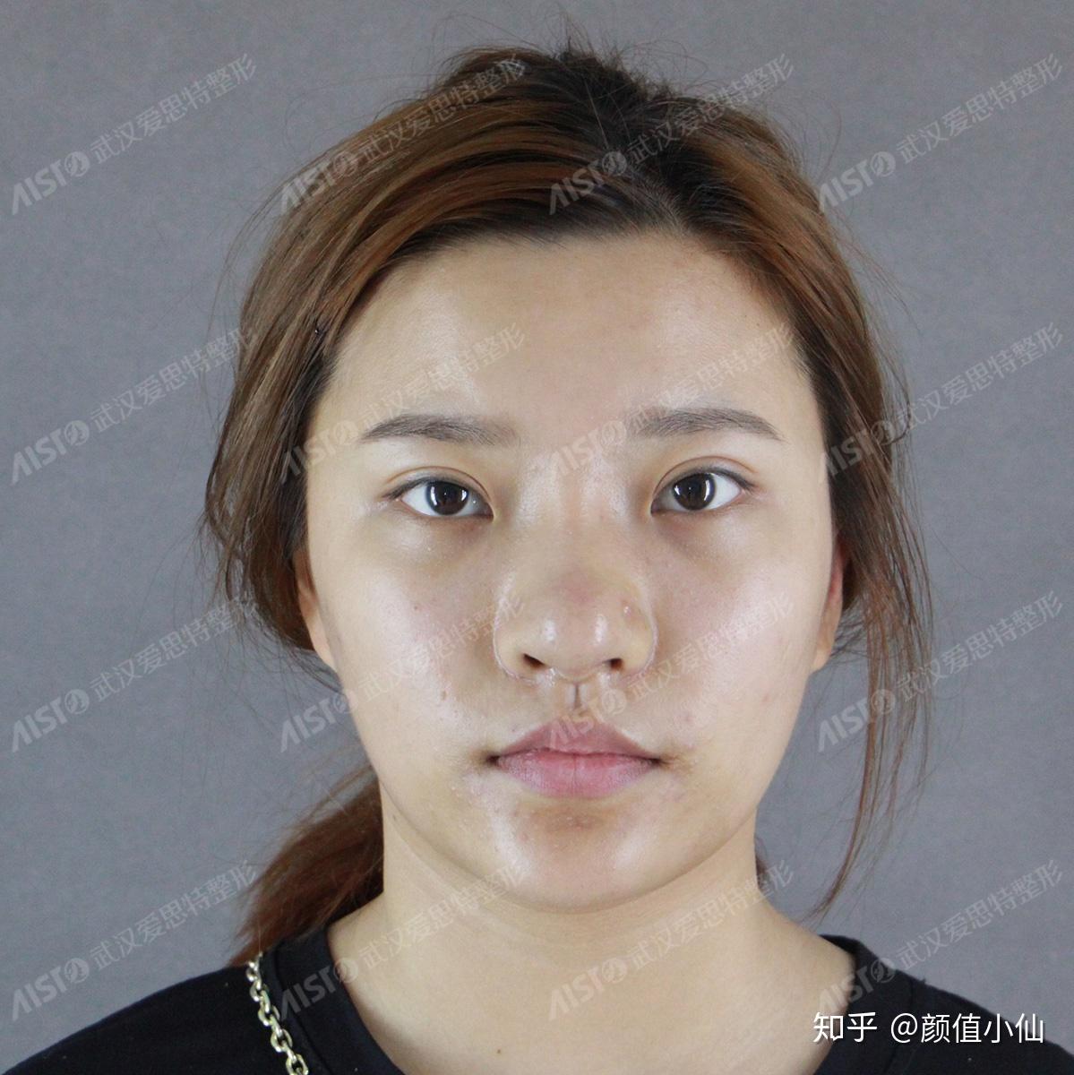 鼻头圆怎么缩小