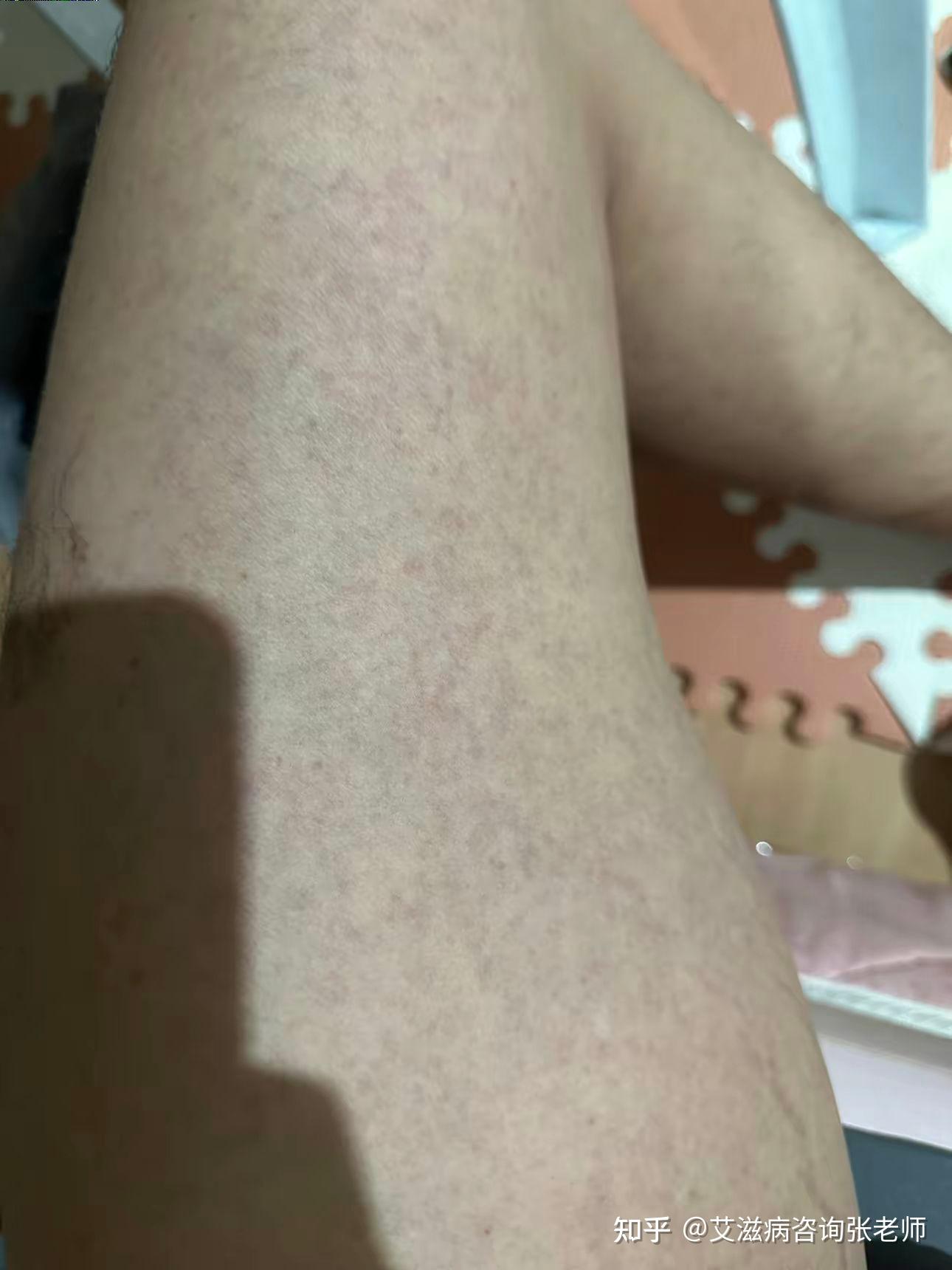 这个是艾滋病红疹吗感觉运动后前胸处于张红疹