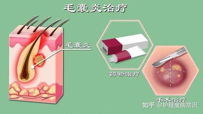 【肤康·科普】毛囊炎越来越严重 都是不重视惹的祸 - 知乎