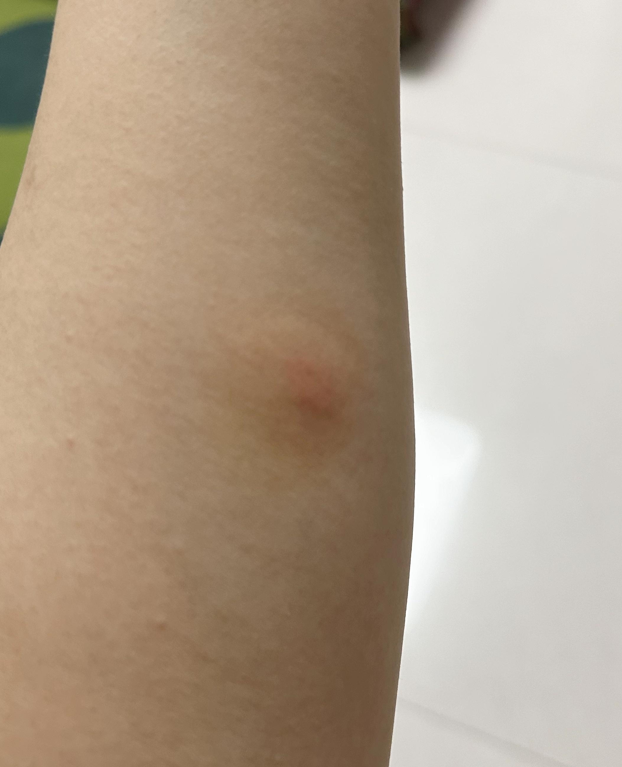 被蜘蛛咬了的伤口图片