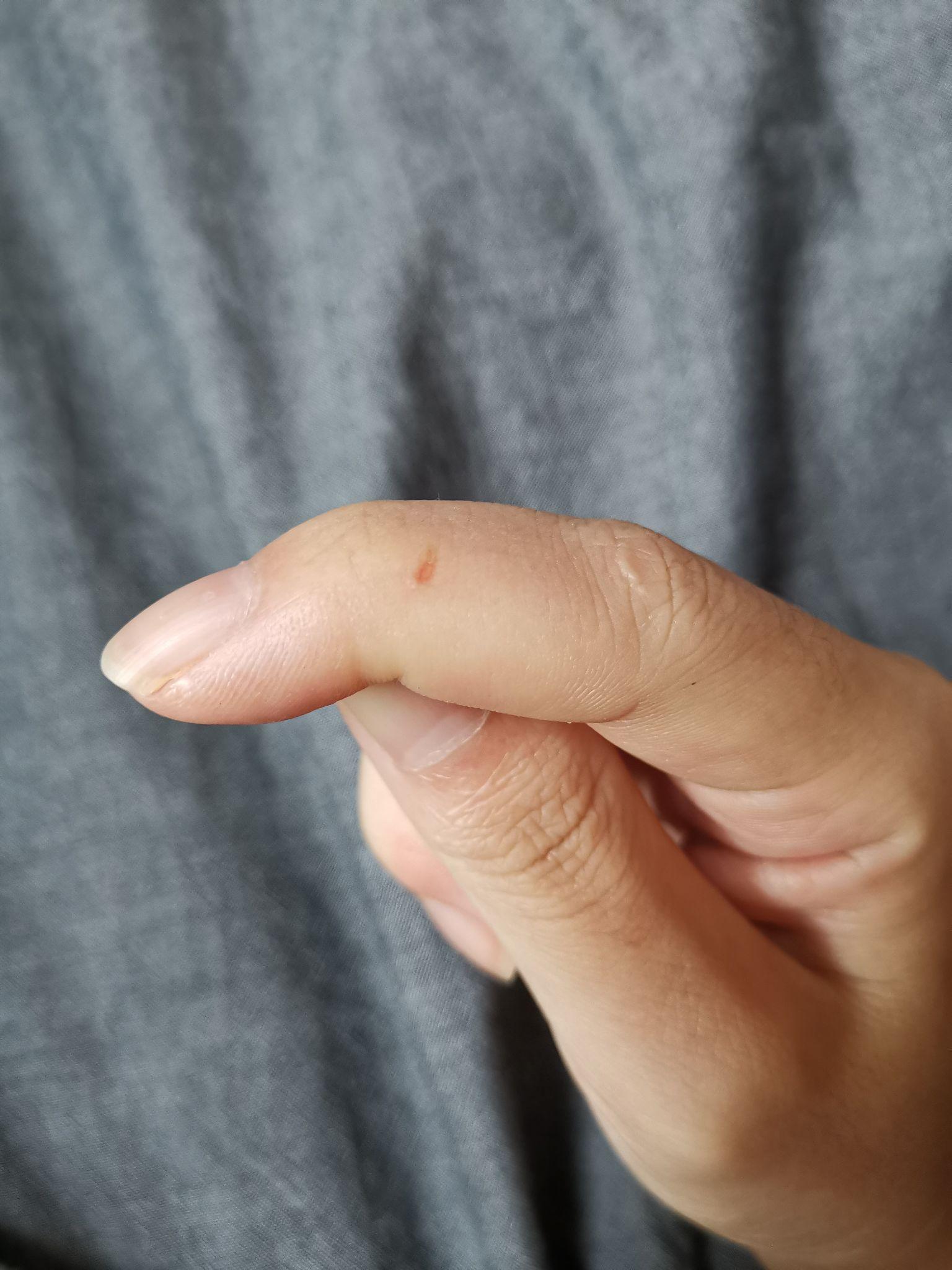 为什么手上总是莫名其妙出现伤口？ - 知乎