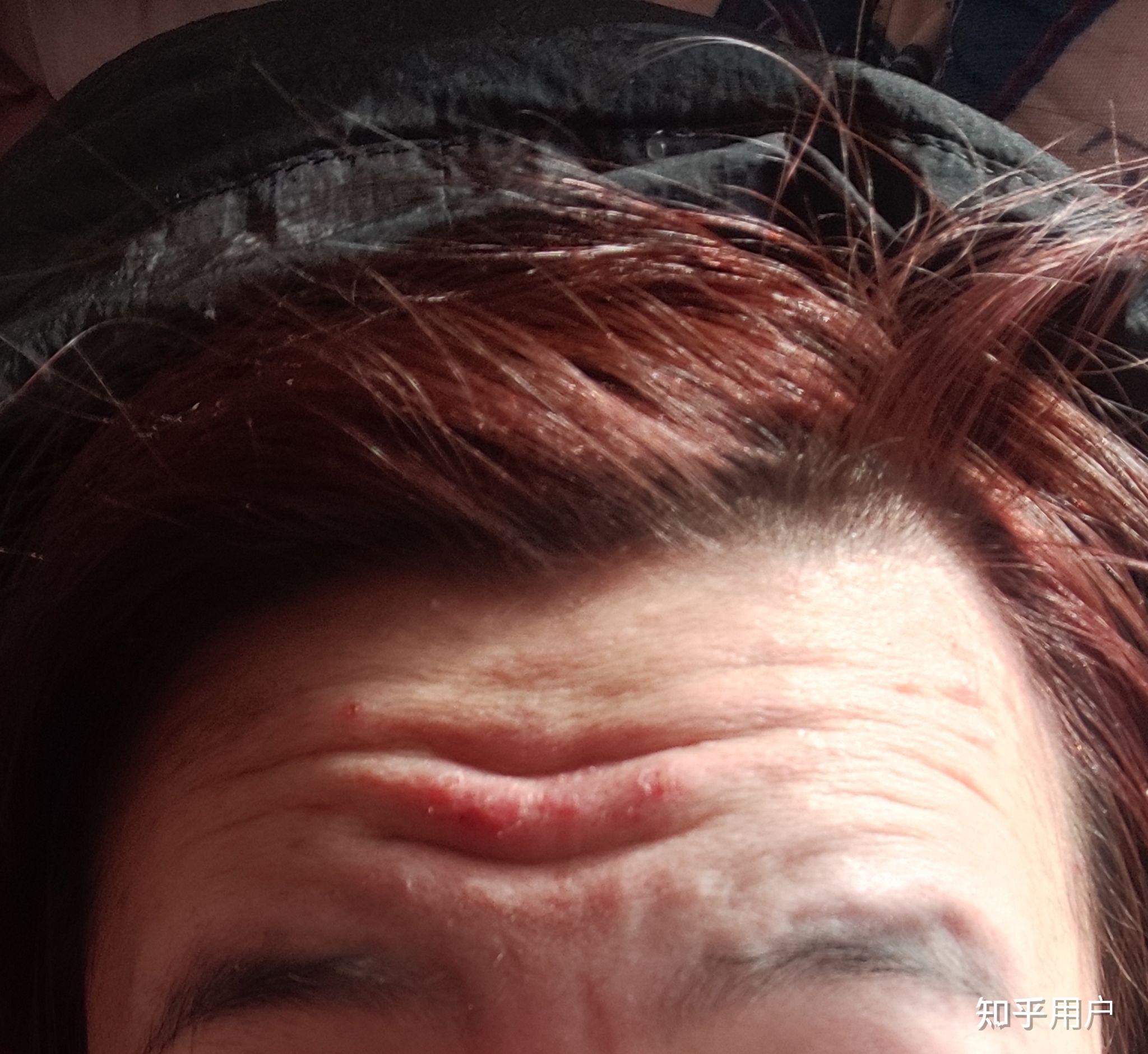 17岁的女孩抬头纹特别严重怎么办